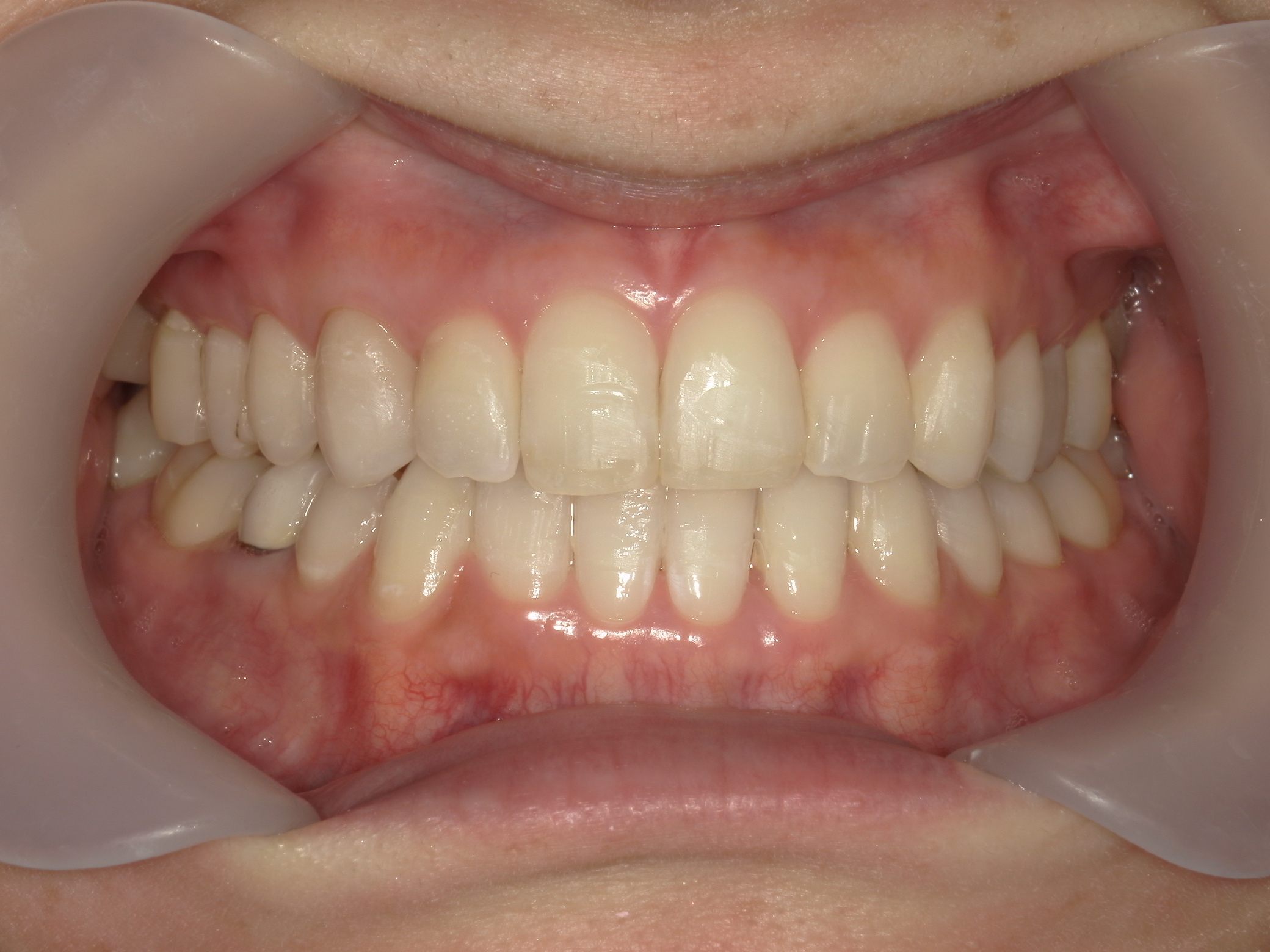 プチワイヤー矯正　症例（51）