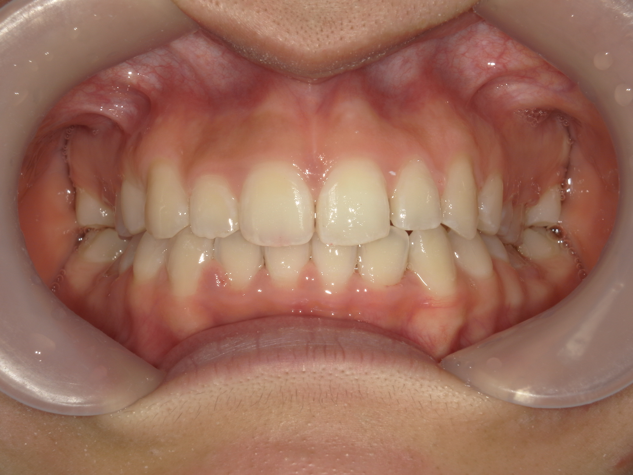 プチワイヤー矯正　症例（54）
