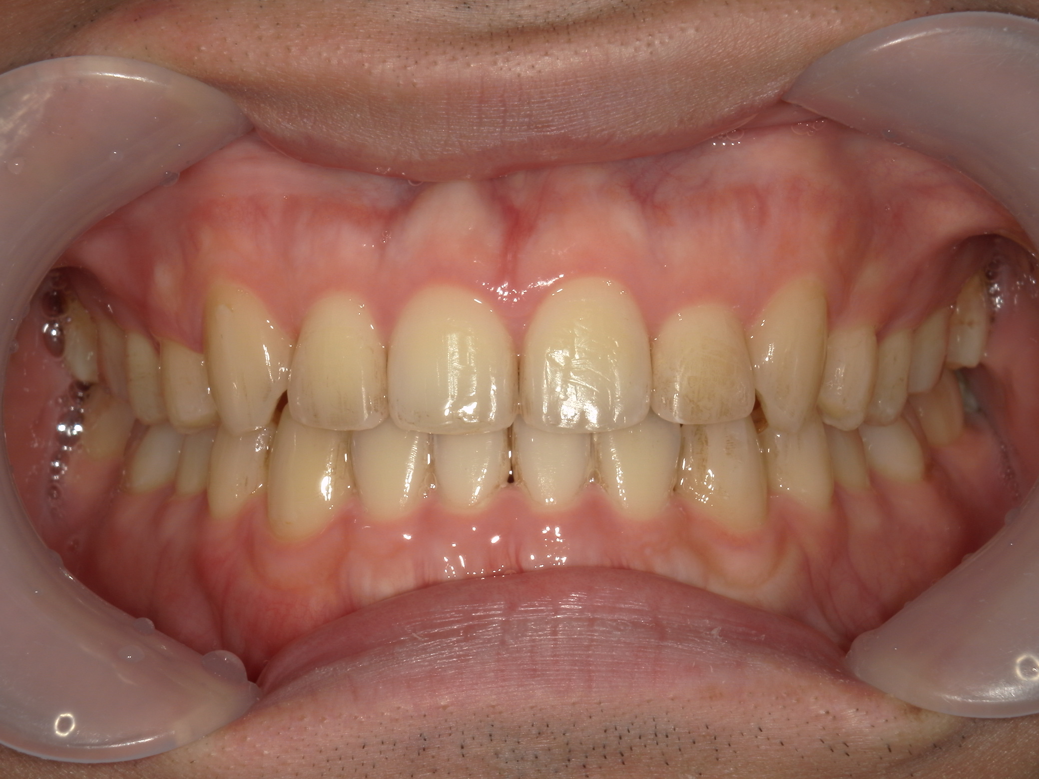 インビザライン矯正　症例（29）