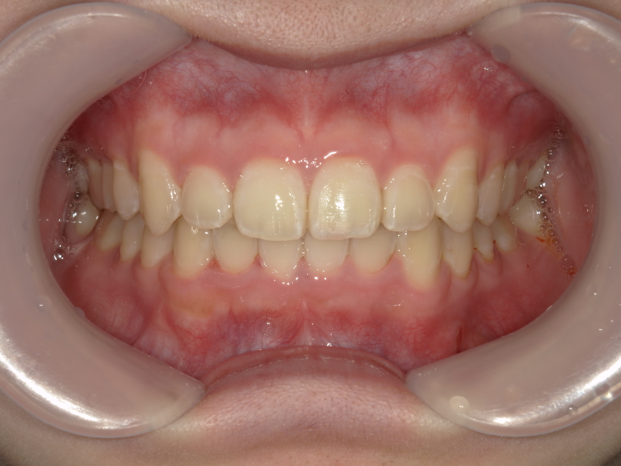 プチワイヤー矯正　症例（55）