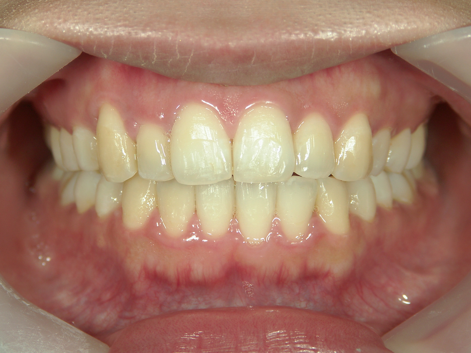 プチワイヤー矯正　症例（56）