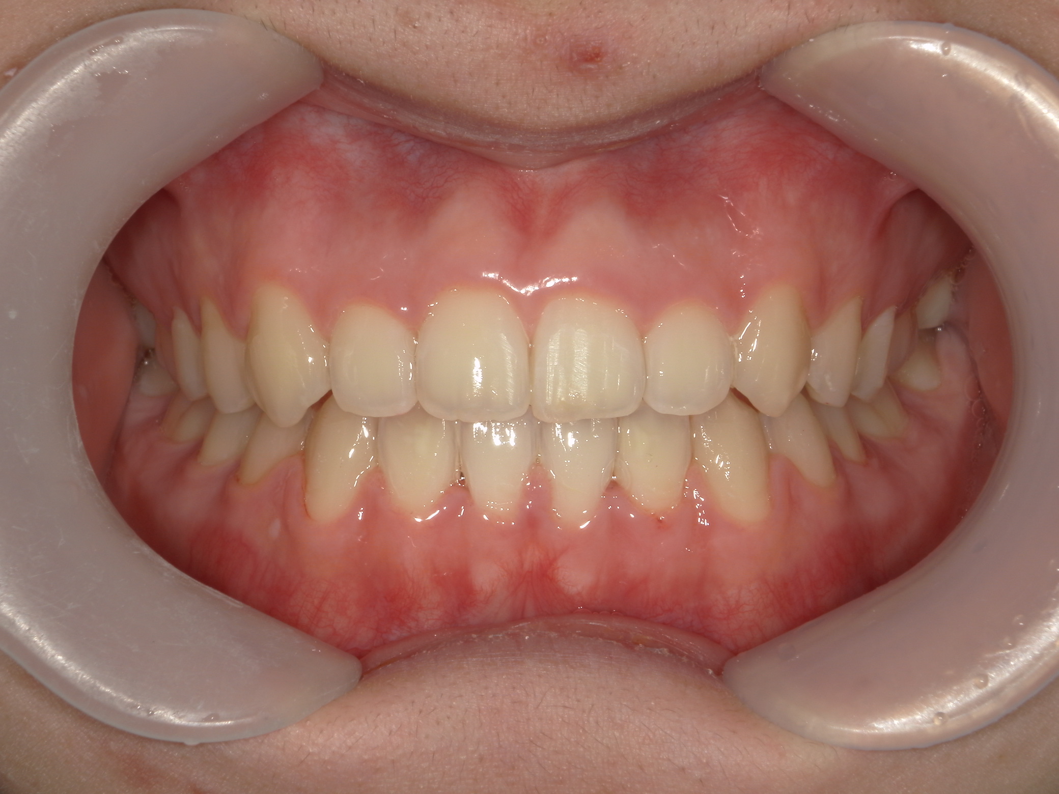 プチワイヤー矯正　症例（57）