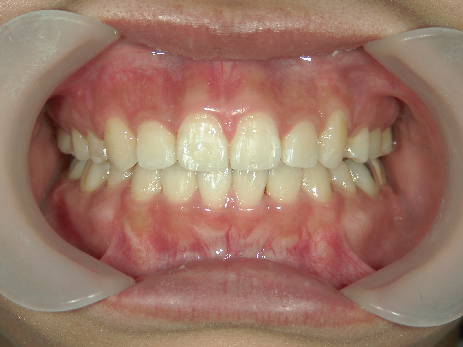 全顎ワイヤー矯正　症例（78）