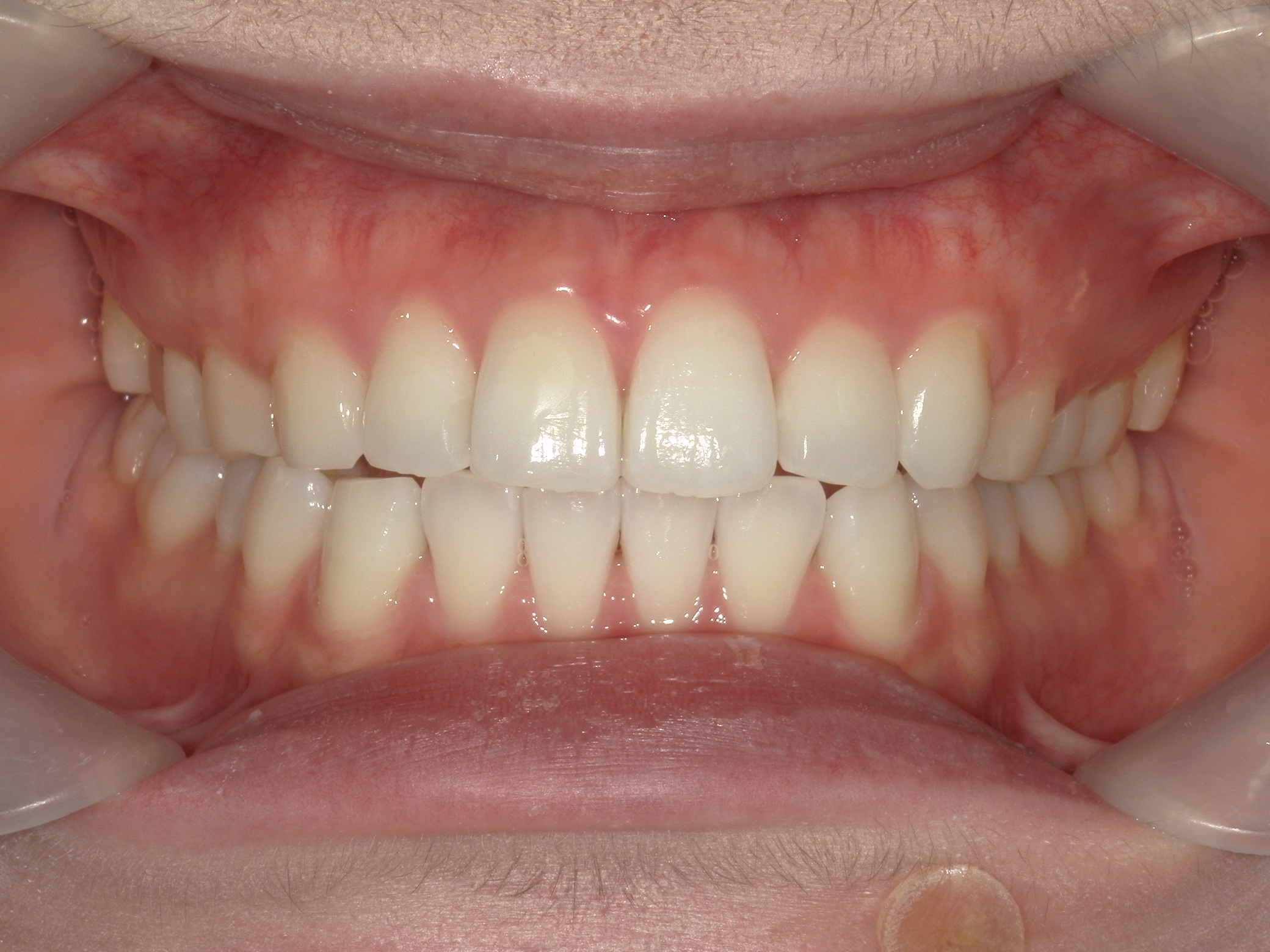 インビザライン矯正(㊤ライト)症例（27）
