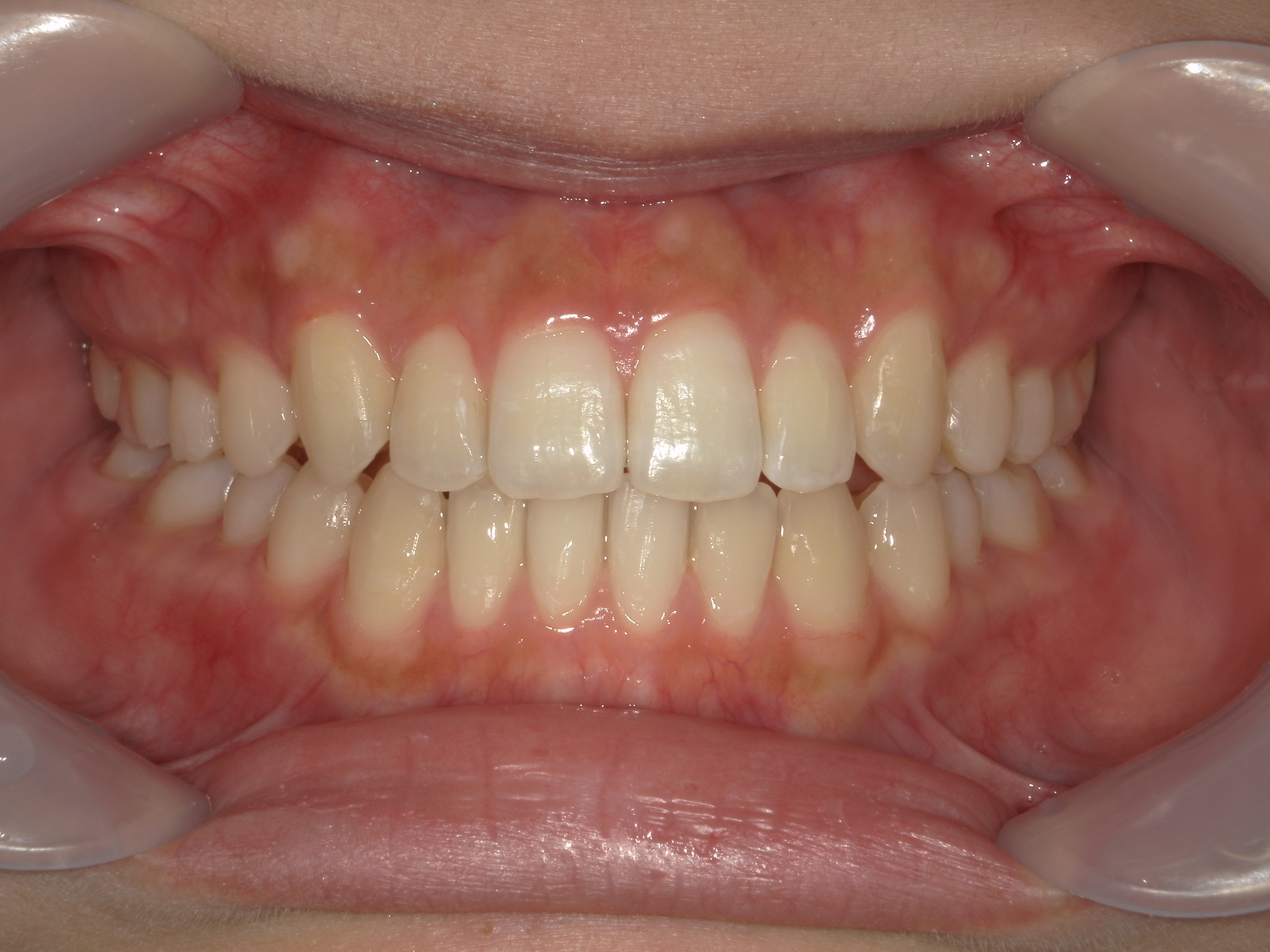 インビザライン(ライト)矯正　症例（28）