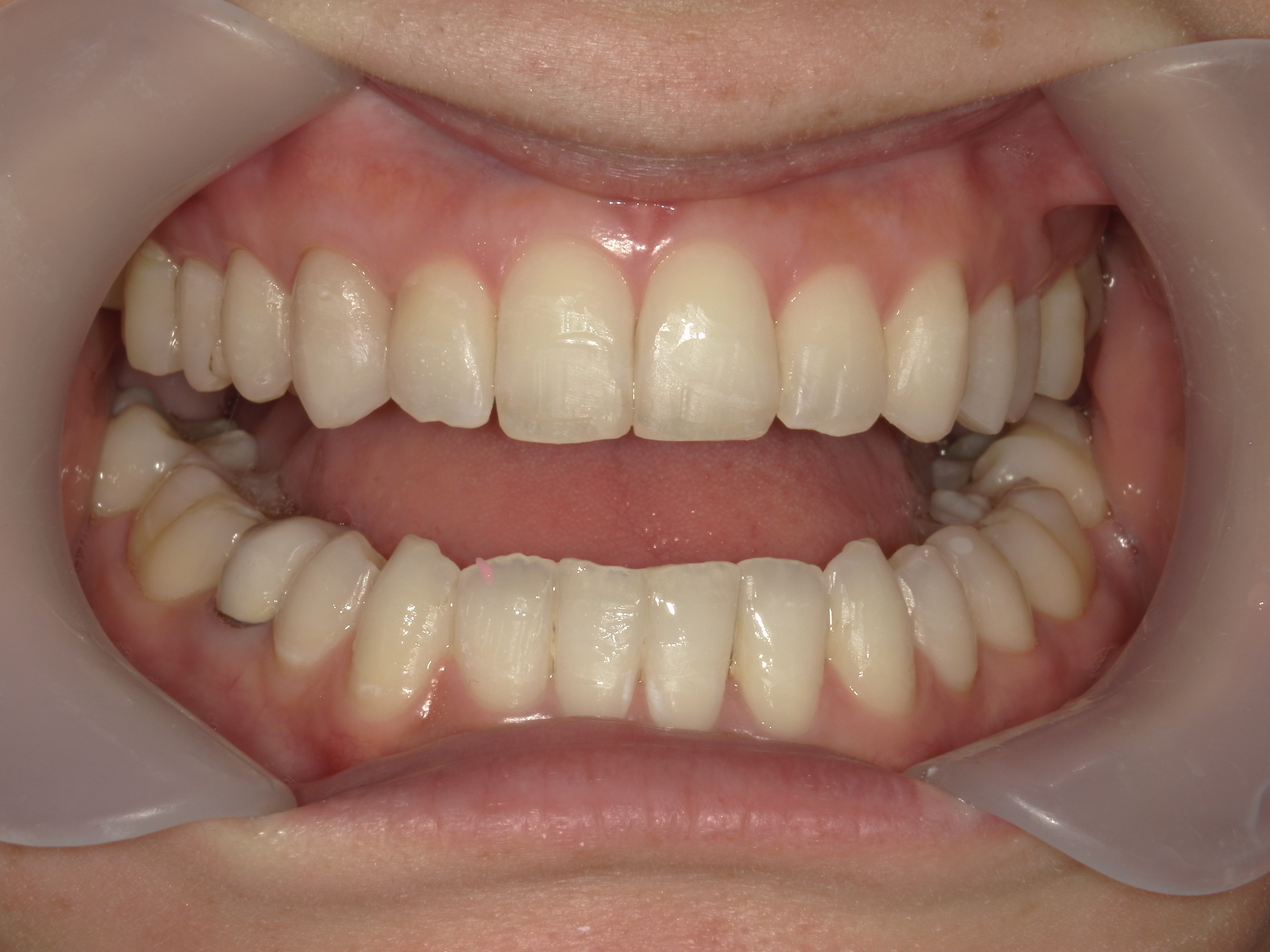 プチワイヤー矯正　症例（51）