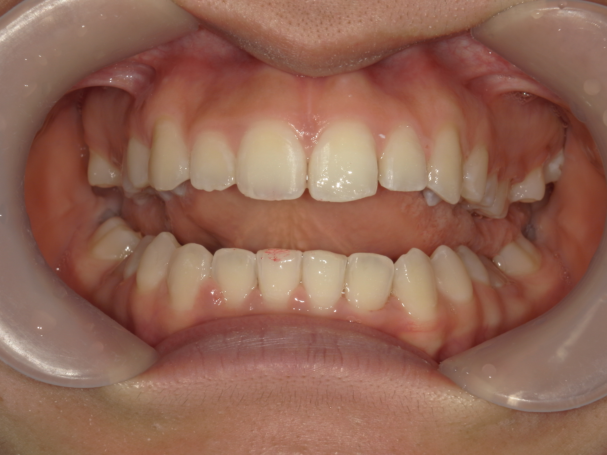プチワイヤー矯正　症例（54）