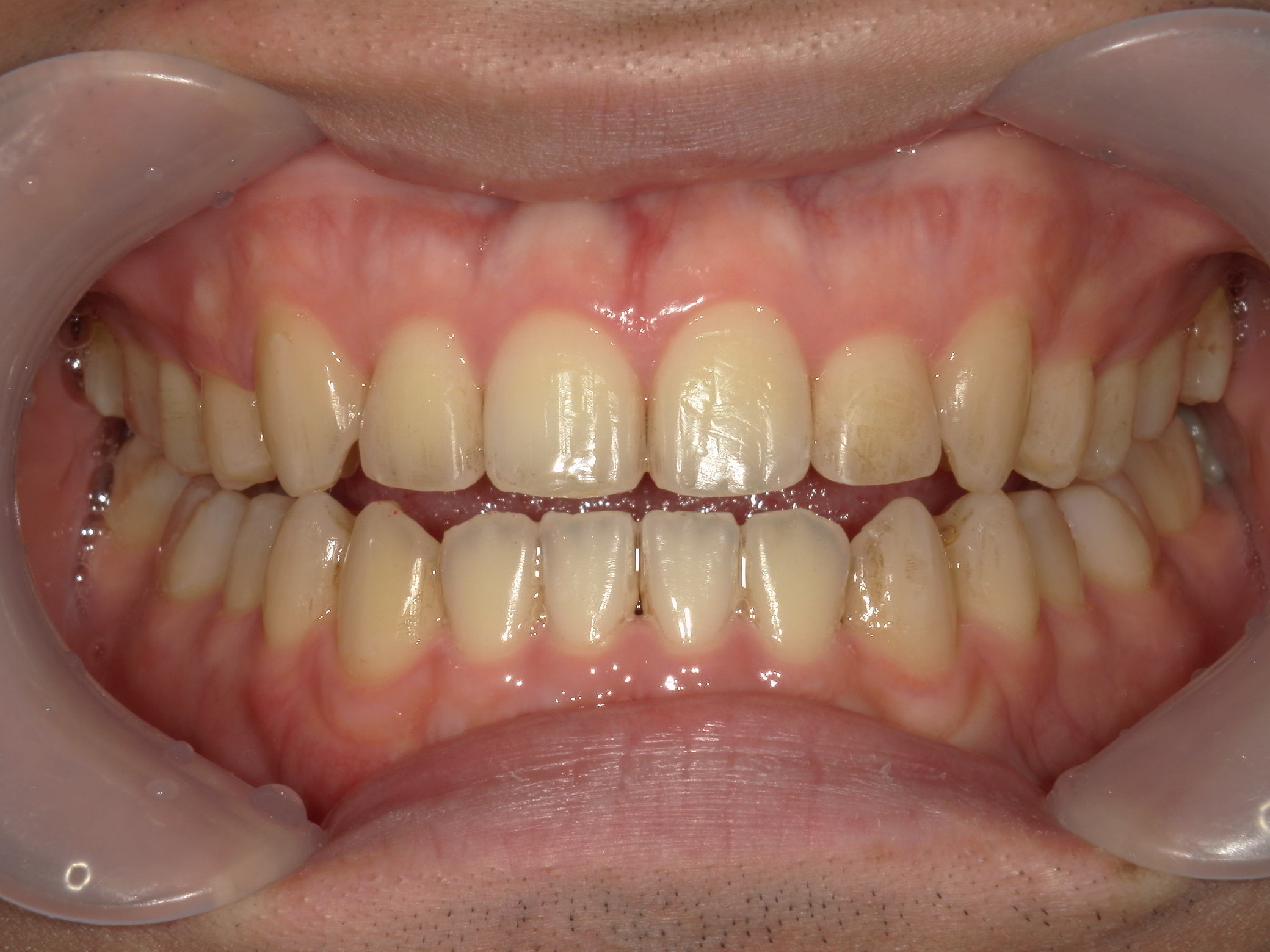 インビザライン矯正　症例（29）