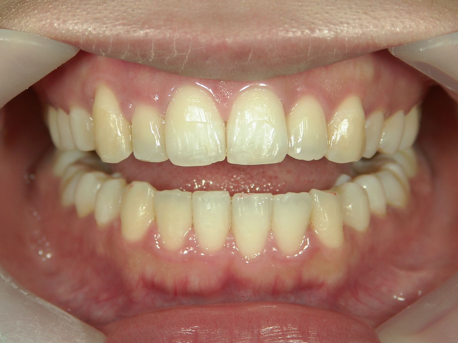 プチワイヤー矯正　症例（56）