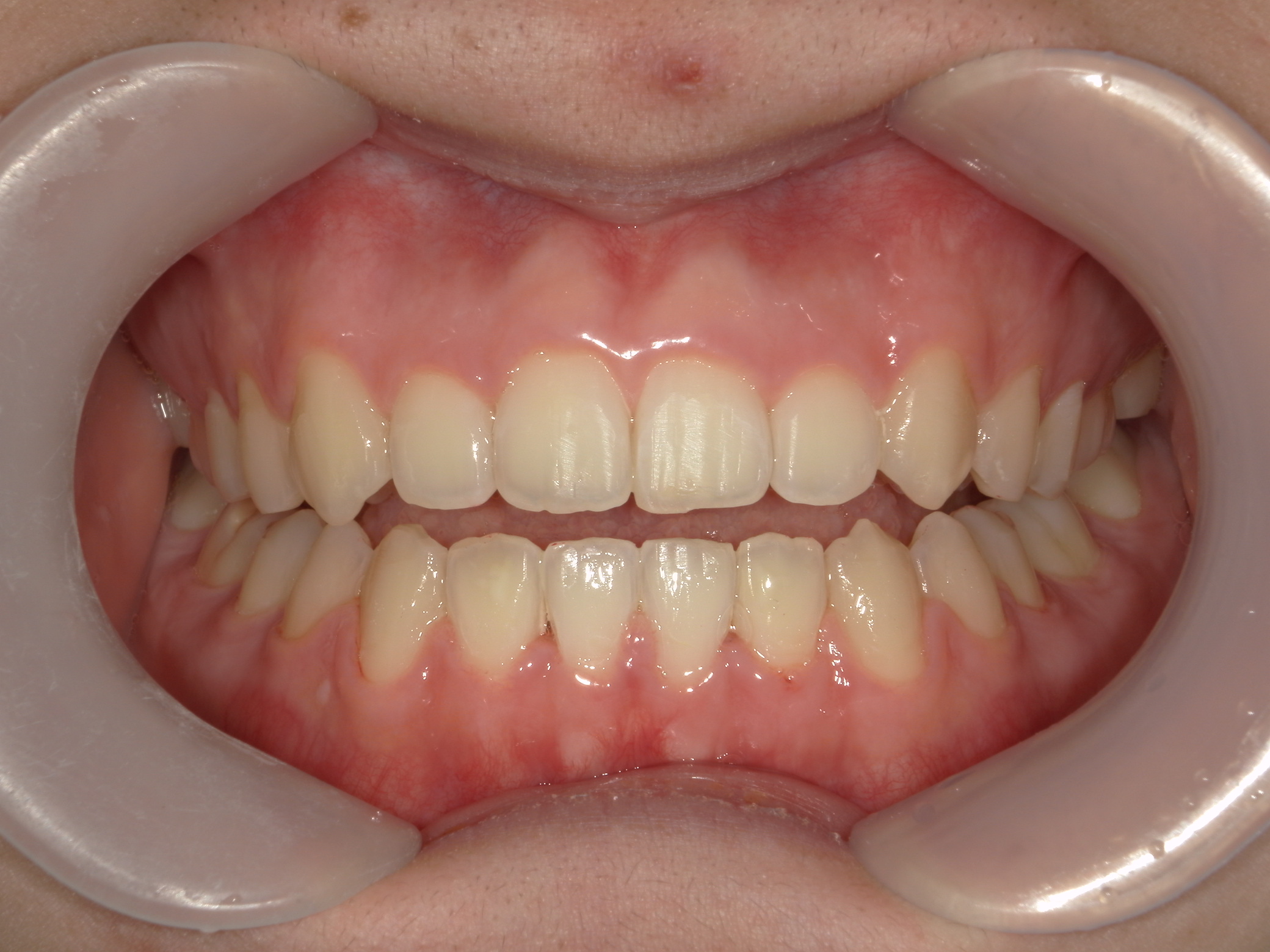 プチワイヤー矯正　症例（57）