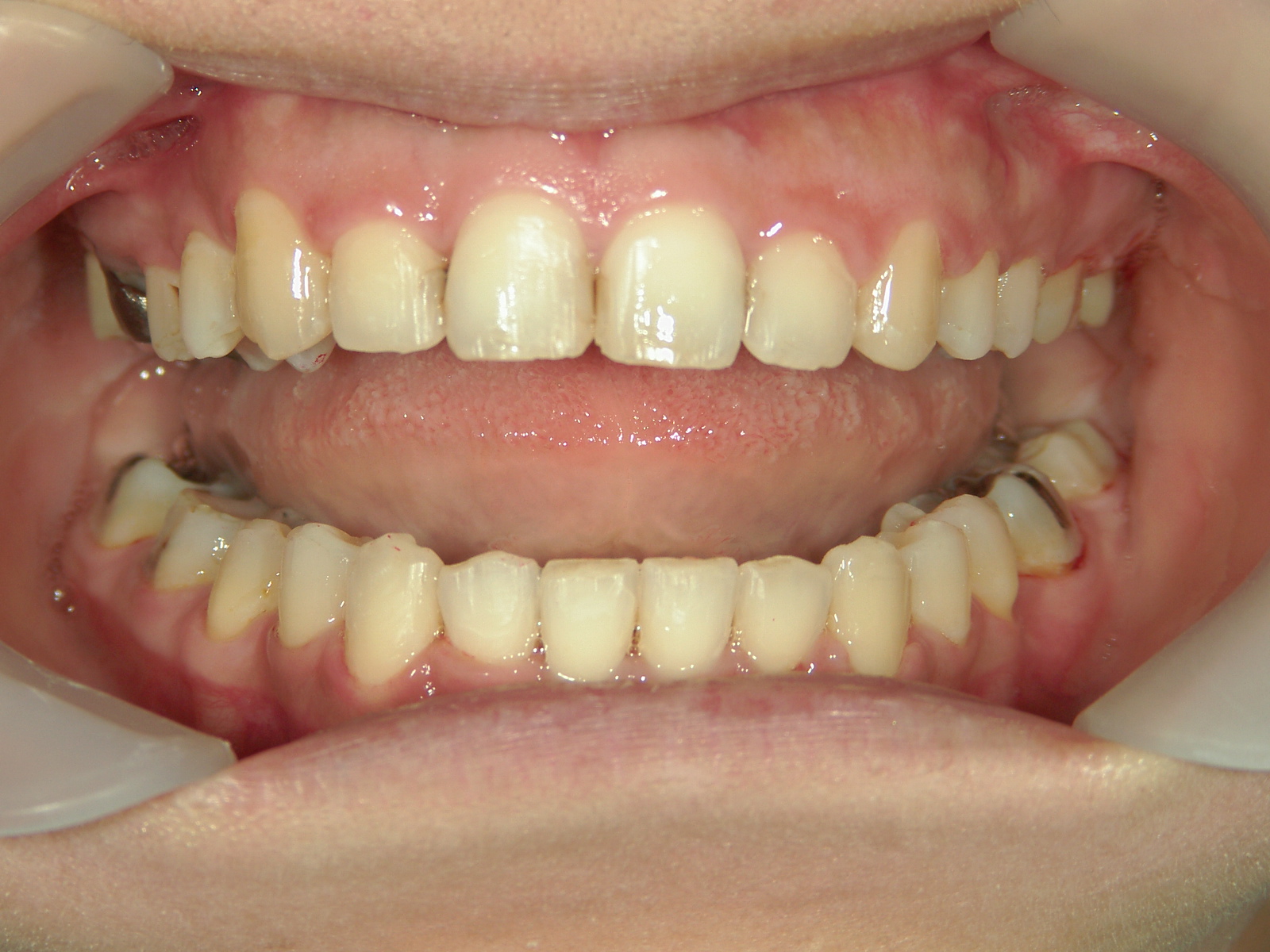 全顎ワイヤー矯正　症例（76）