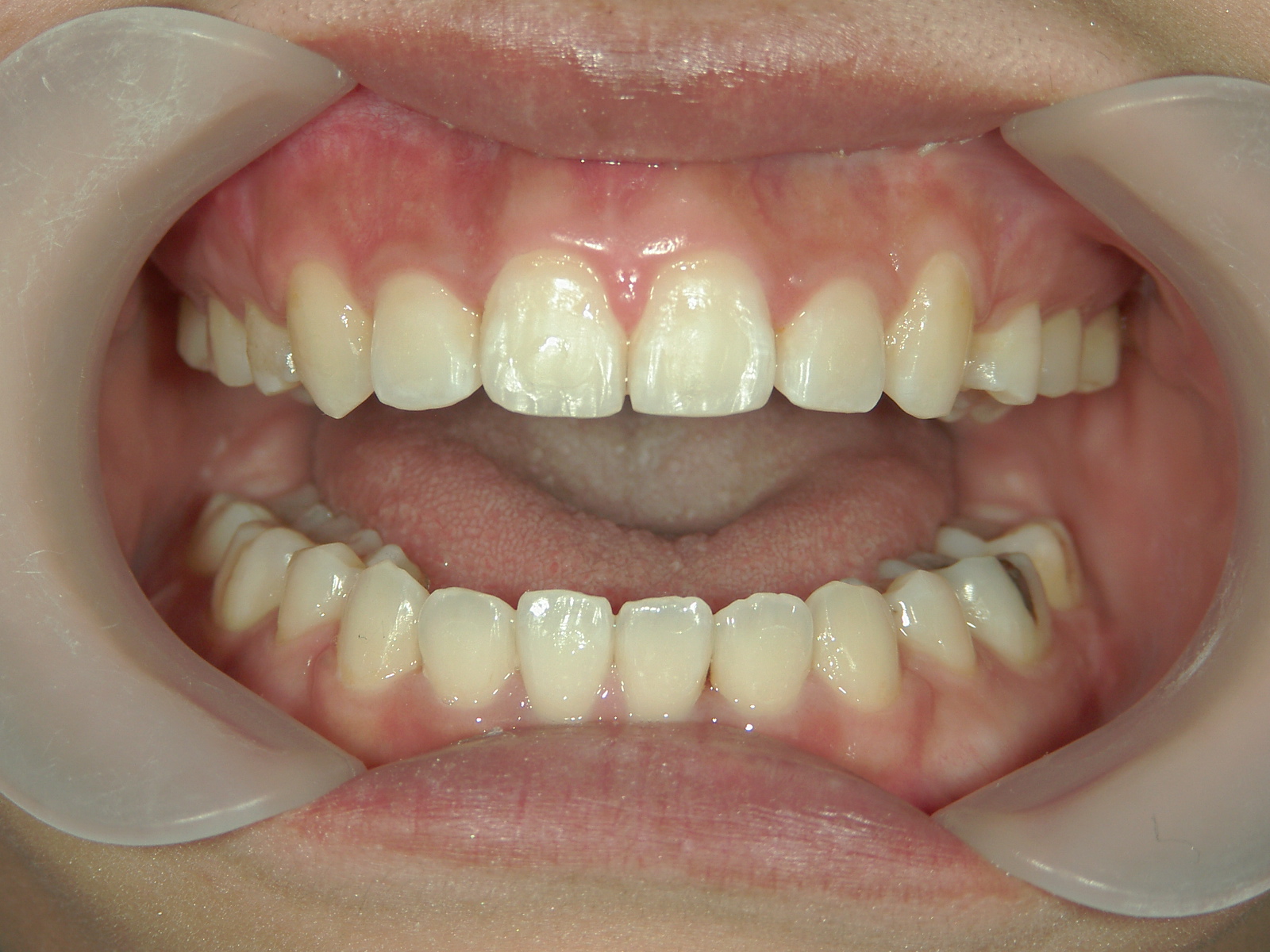 全顎ワイヤー矯正　症例（78）