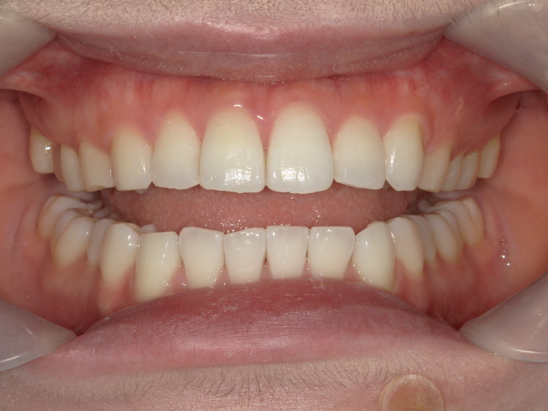 インビザライン矯正(㊤ライト)症例（27）
