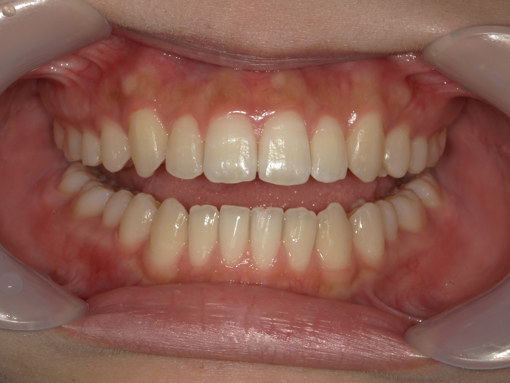 インビザライン(ライト)矯正　症例（28）