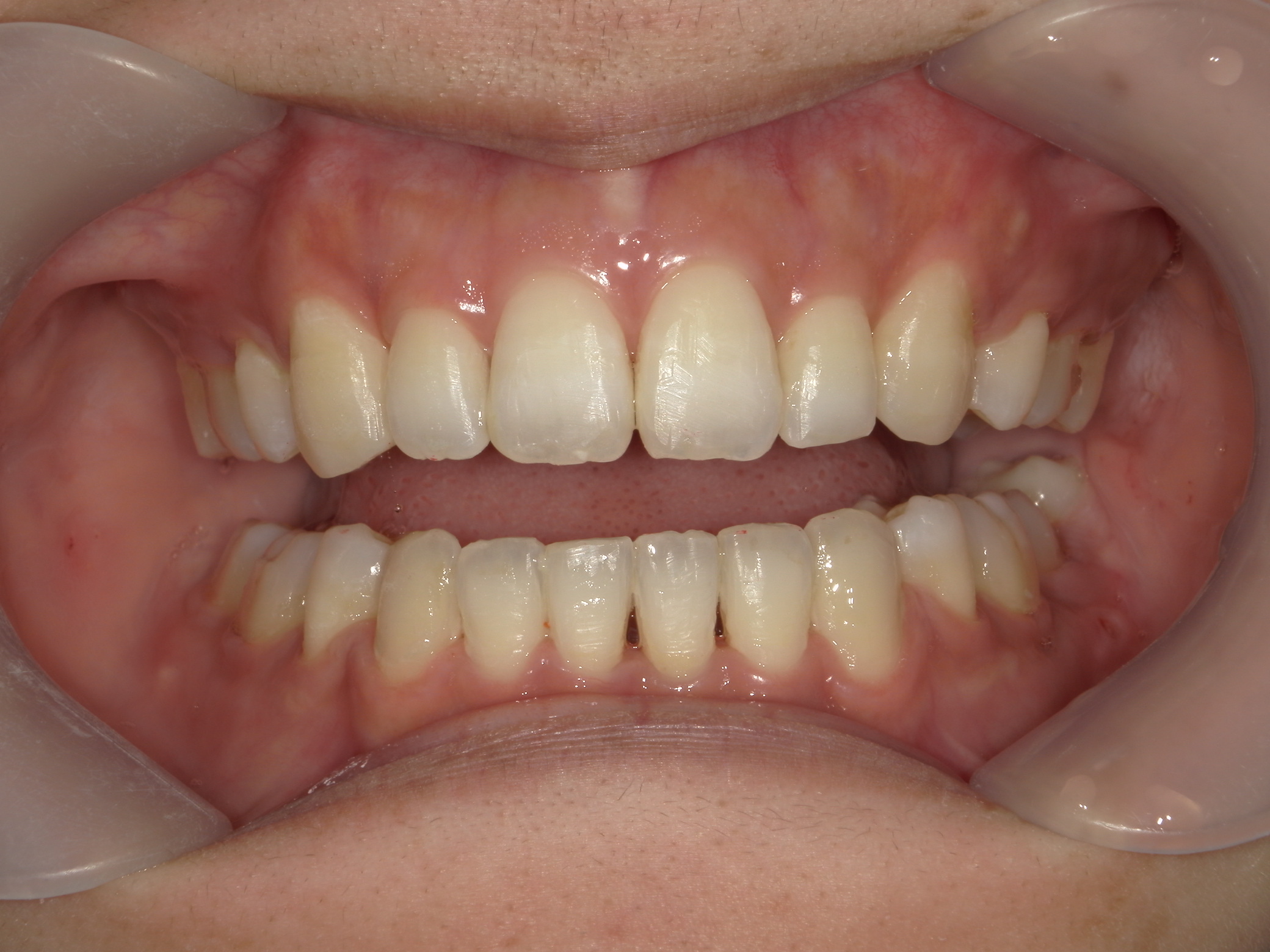 全顎ワイヤー矯正　症例（75）