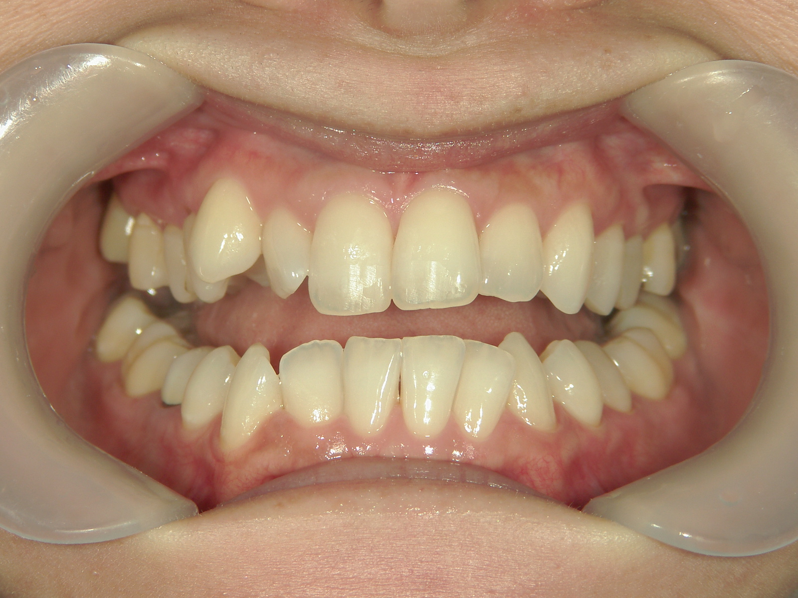 プチワイヤー矯正　症例（51）