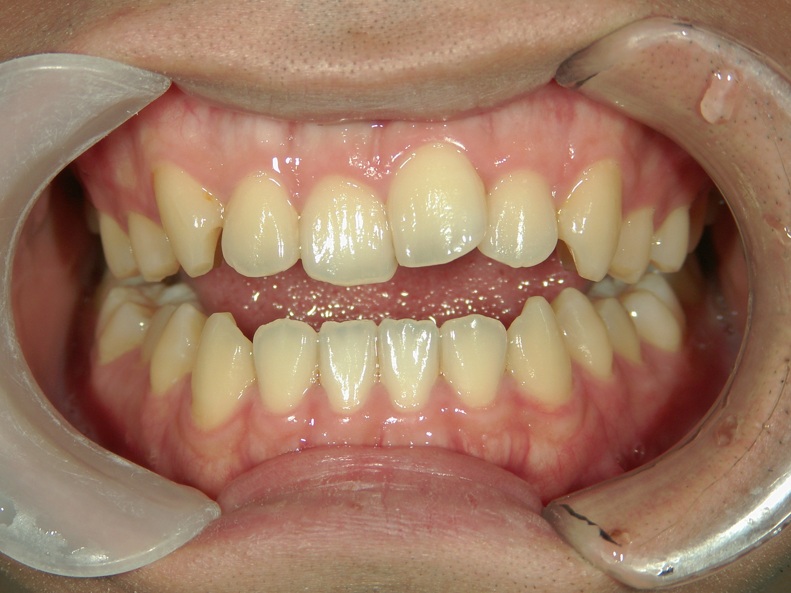 インビザライン矯正　症例（29）