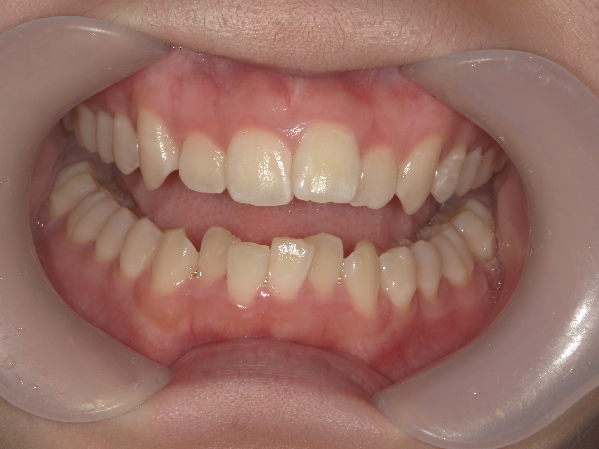 プチワイヤー矯正　症例（55）