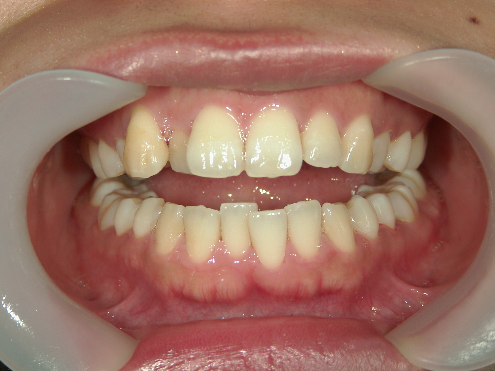 プチワイヤー矯正　症例（56）