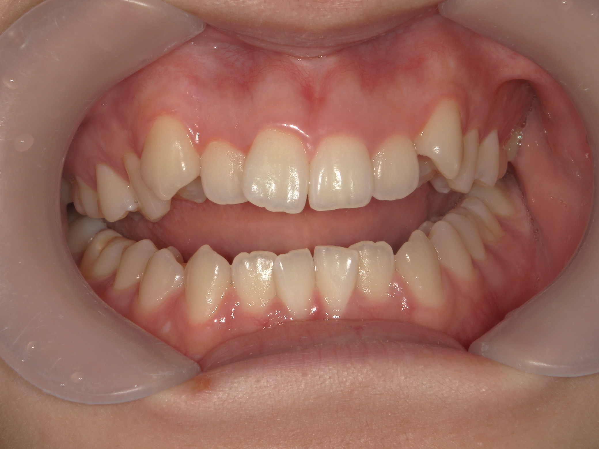 プチワイヤー矯正　症例（57）