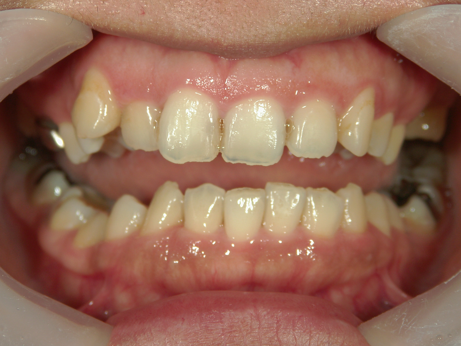 全顎ワイヤー矯正　症例（76）