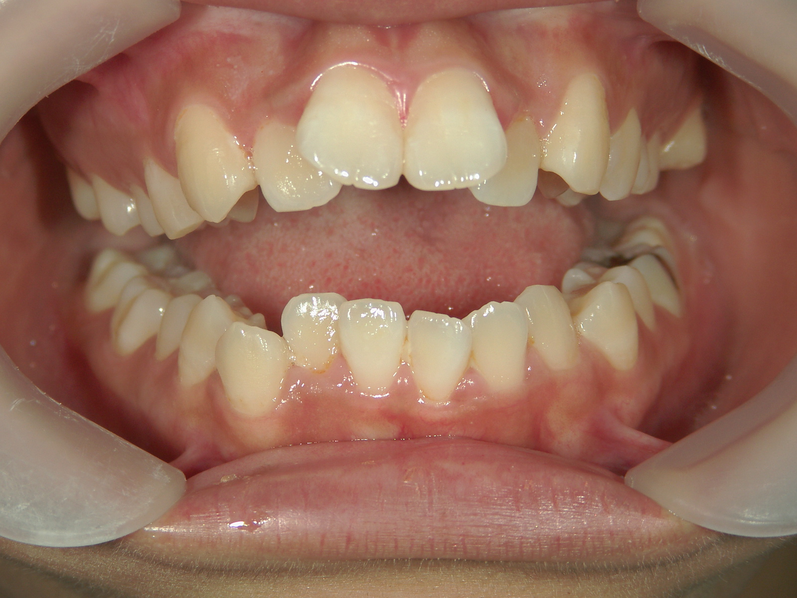 全顎ワイヤー矯正　症例（78）