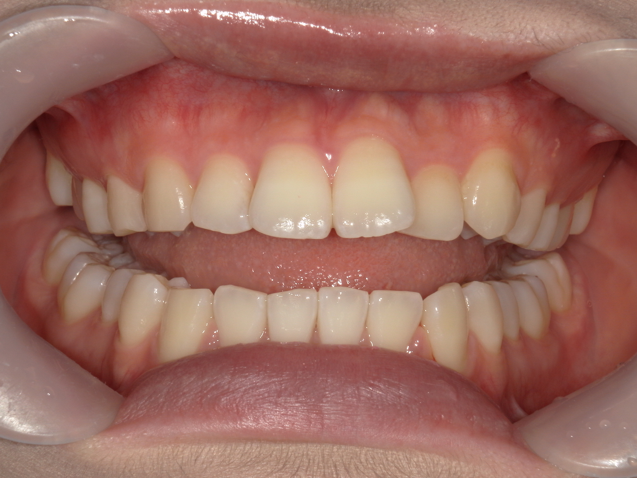 インビザライン矯正(㊤ライト)症例（27）