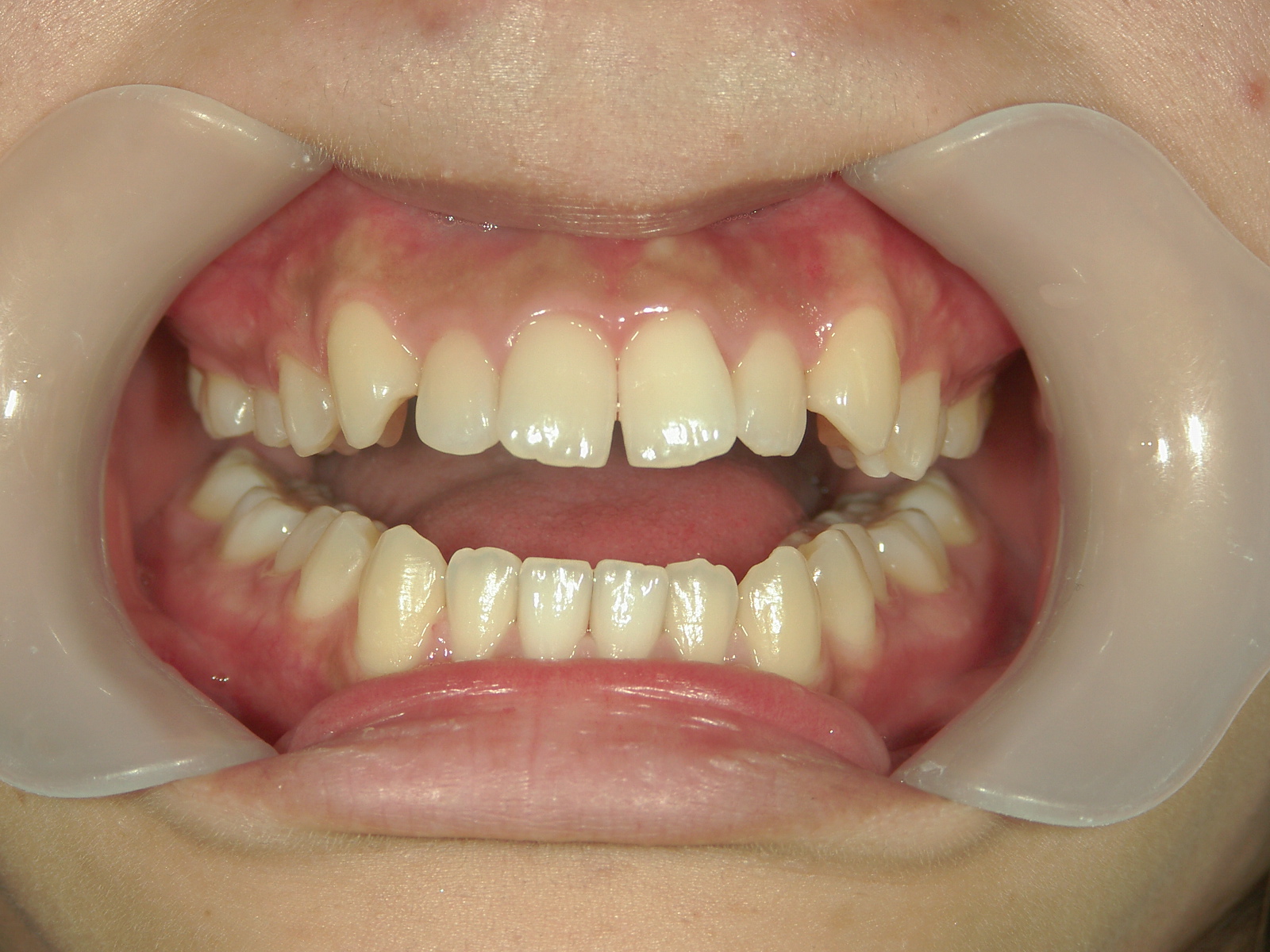 インビザライン(ライト)矯正　症例（28）