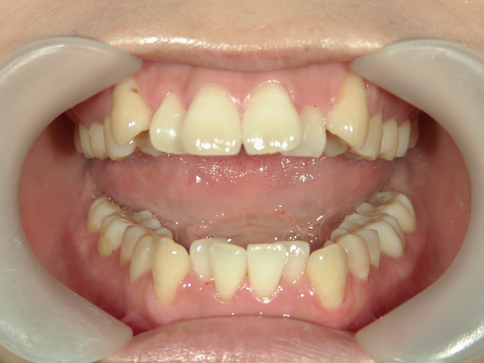 プチワイヤー矯正　症例（53）