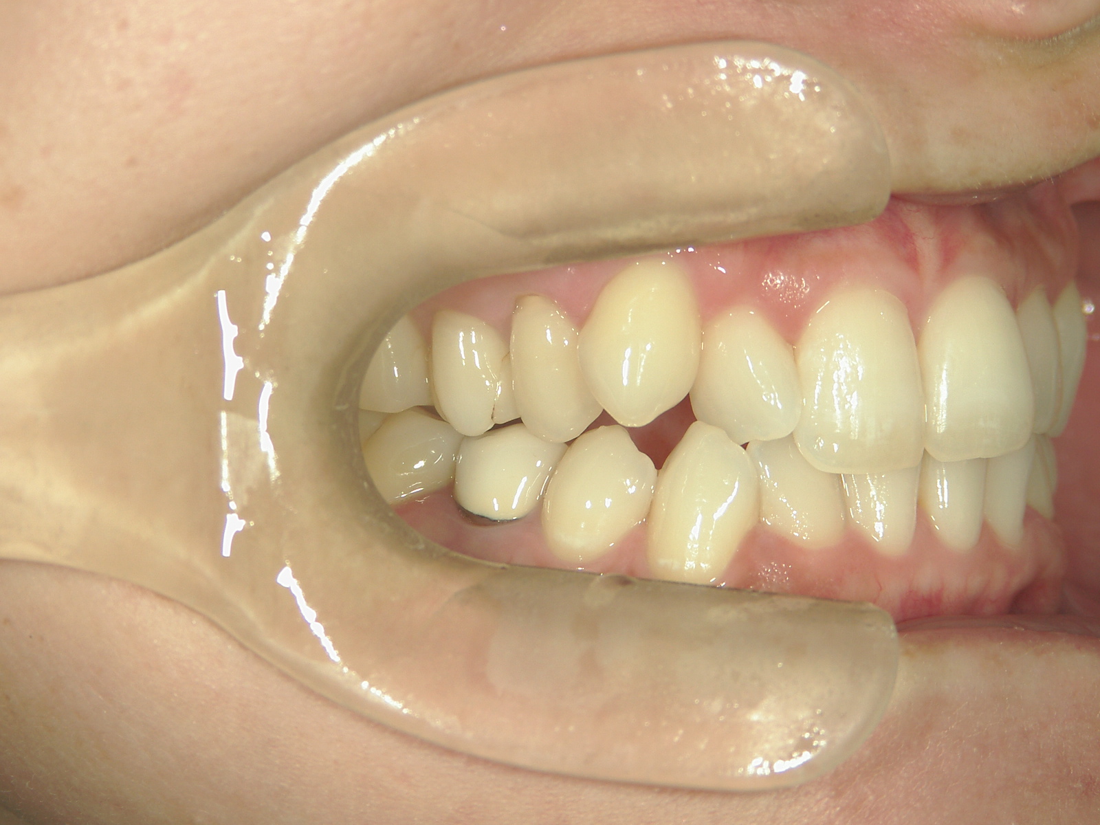 プチワイヤー矯正　症例（51）