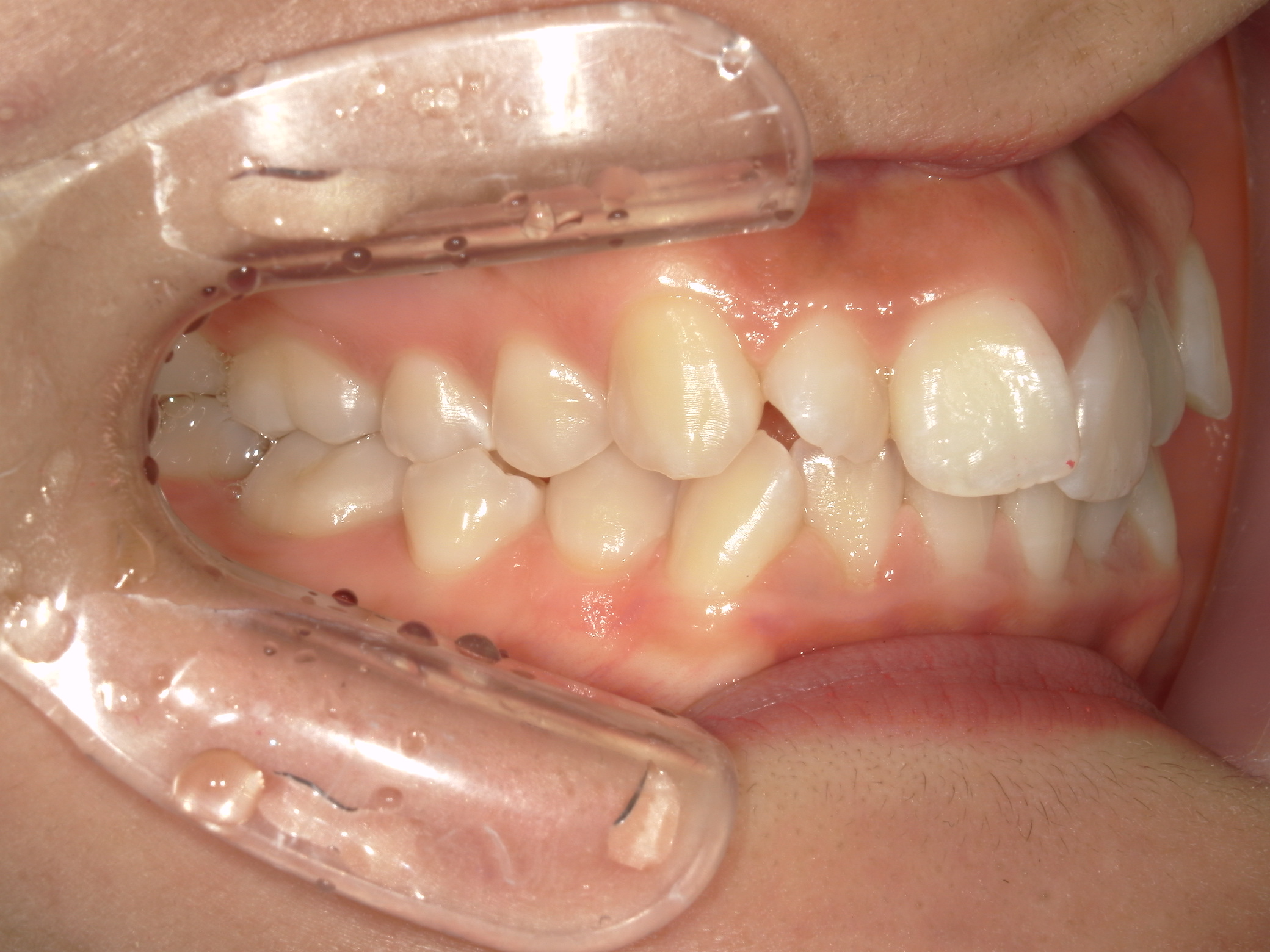 プチワイヤー矯正　症例（54）