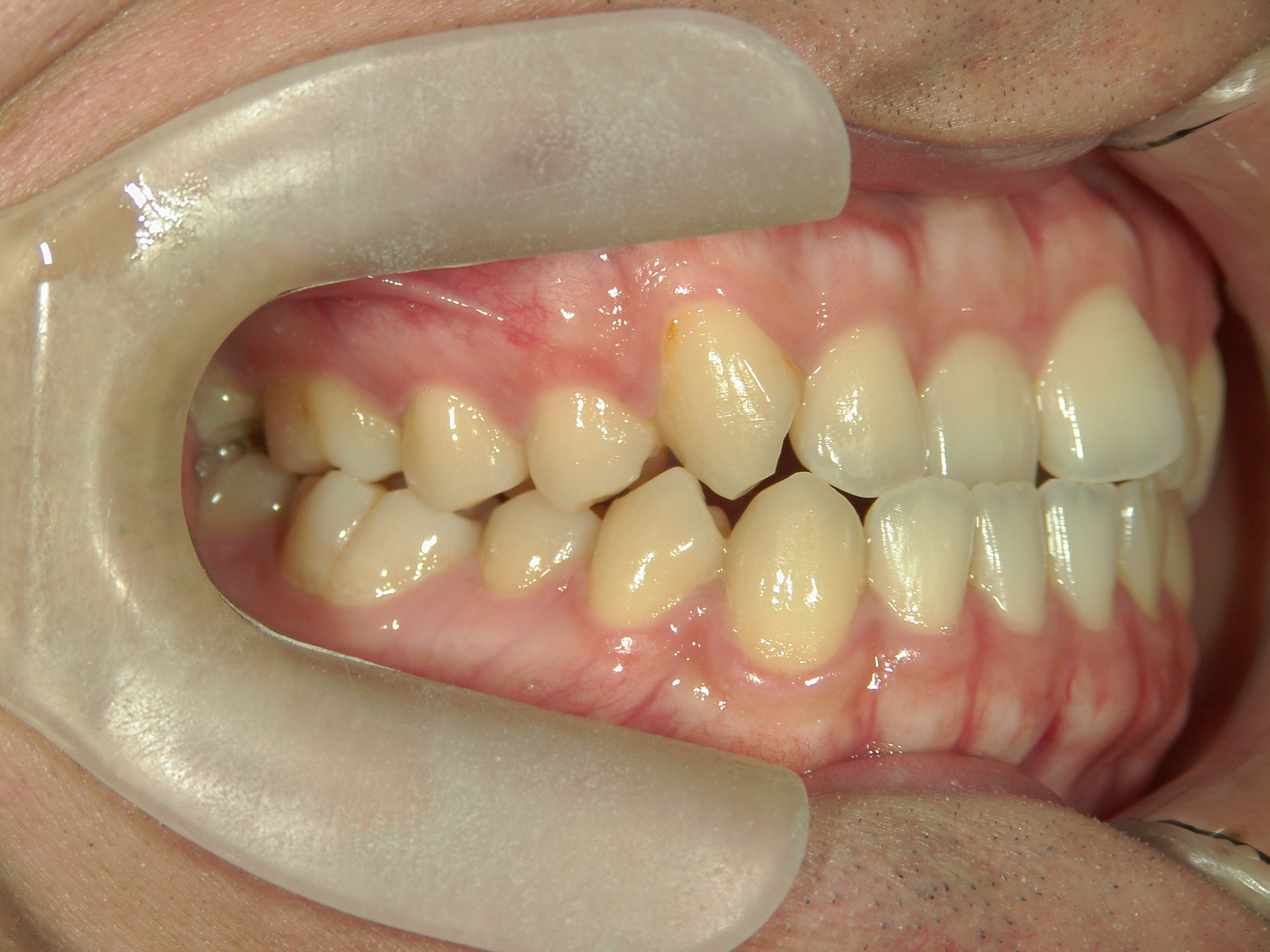 インビザライン矯正　症例（29）