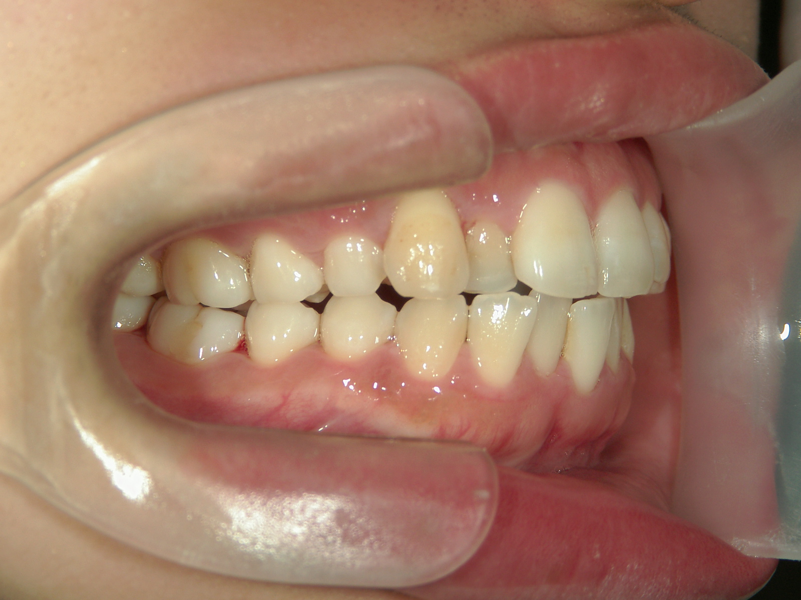 プチワイヤー矯正　症例（56）