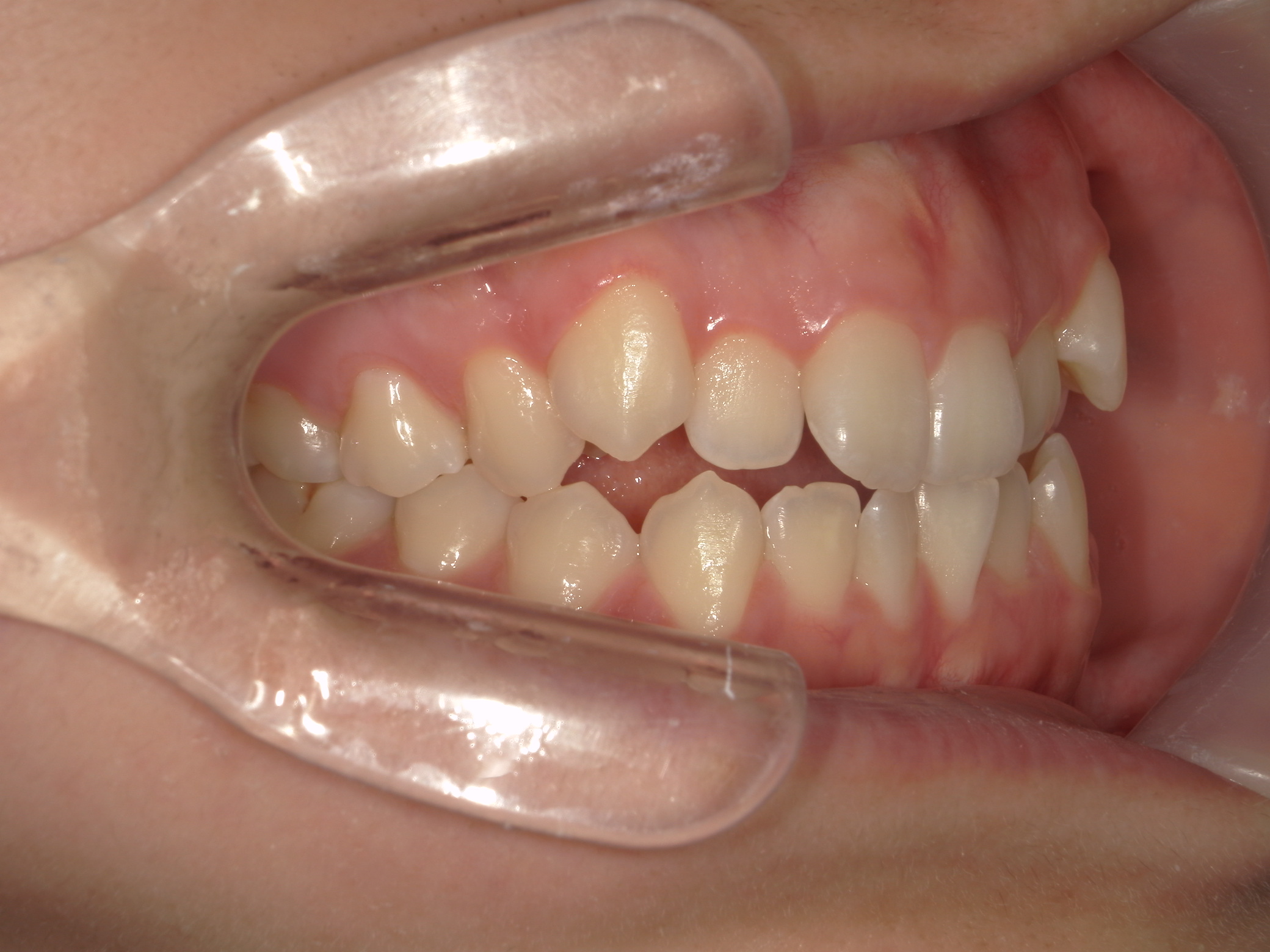 プチワイヤー矯正　症例（57）