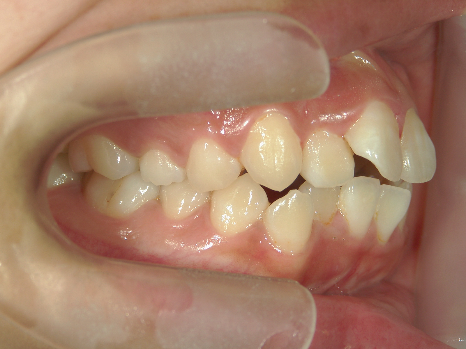 全顎ワイヤー矯正　症例（78）