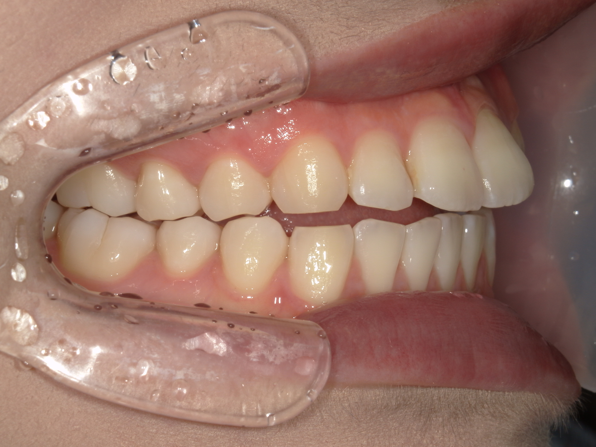 インビザライン矯正(㊤ライト)症例（27）