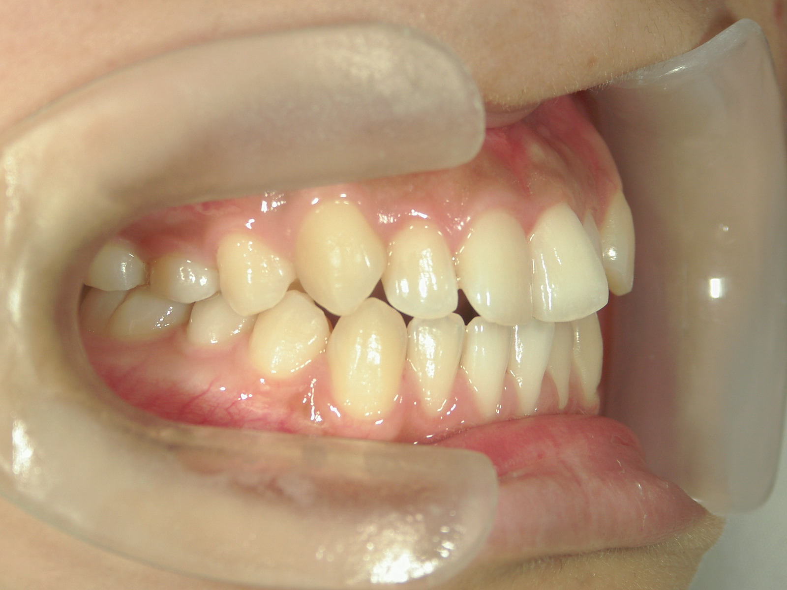 インビザライン(ライト)矯正　症例（28）