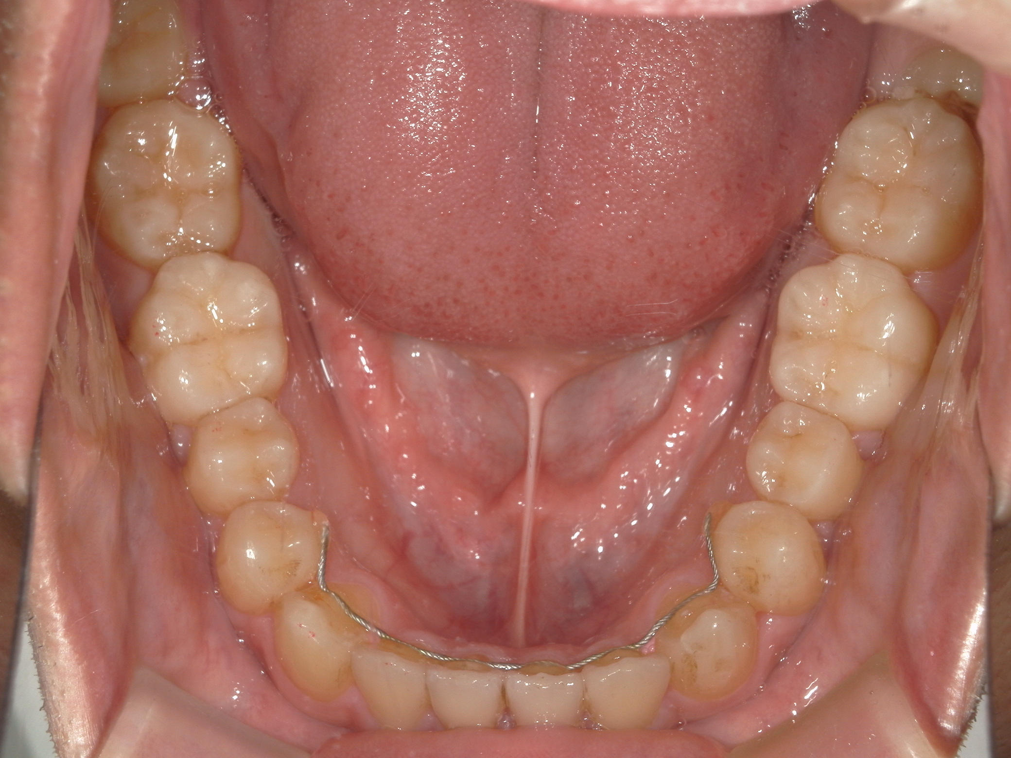 インビザライン矯正　症例（29）
