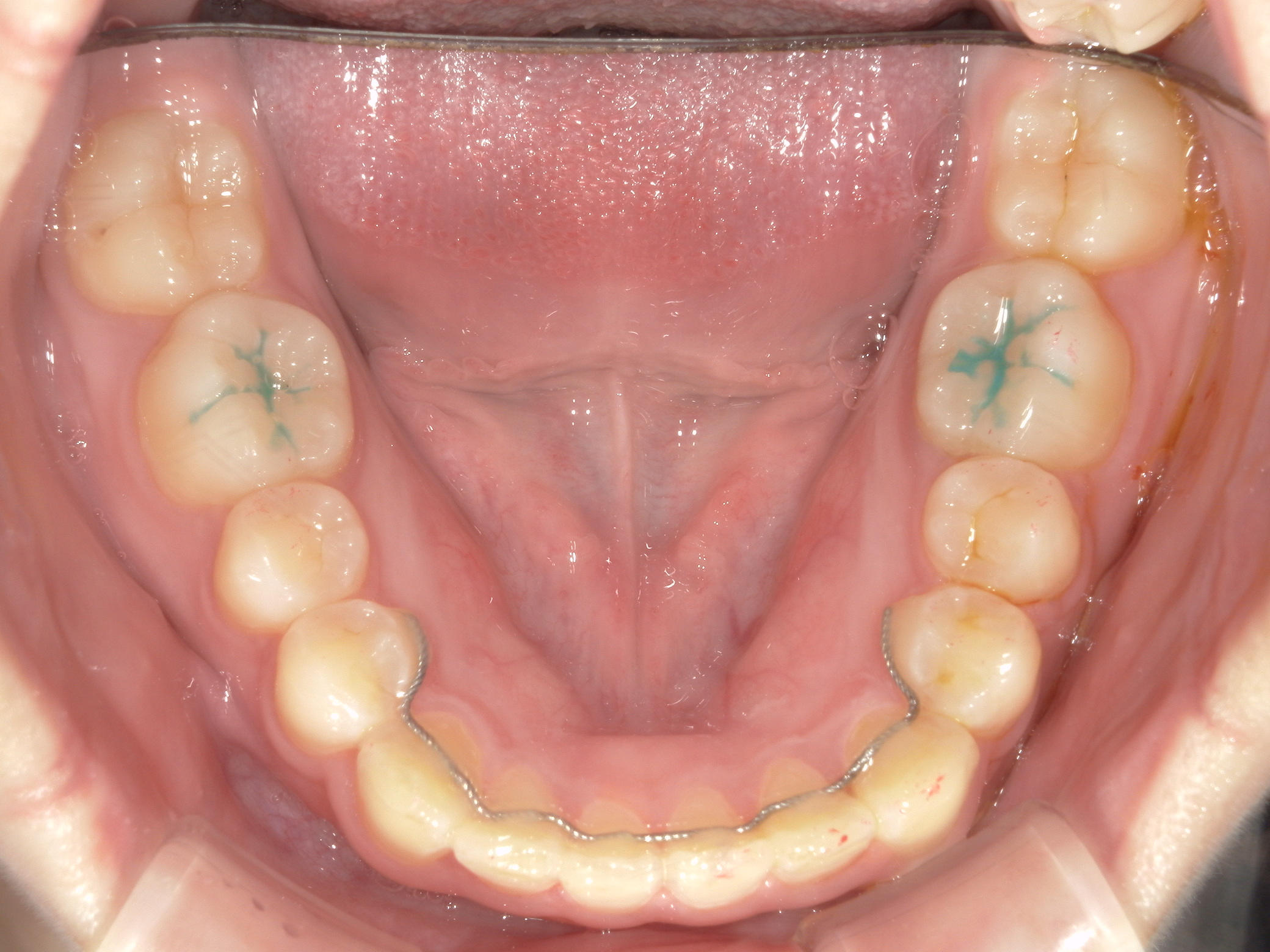 プチワイヤー矯正　症例（55）