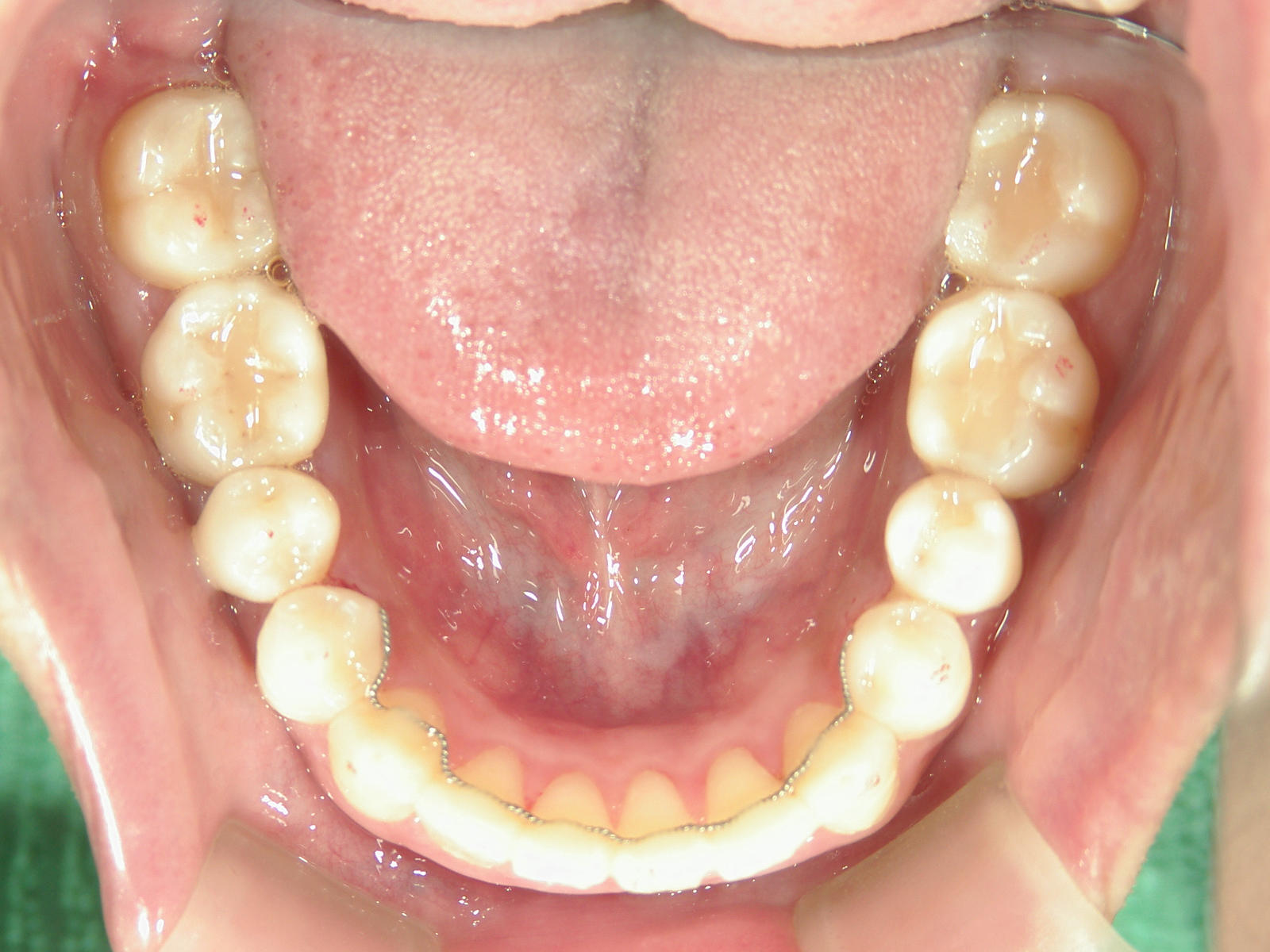 プチワイヤー矯正　症例（56）