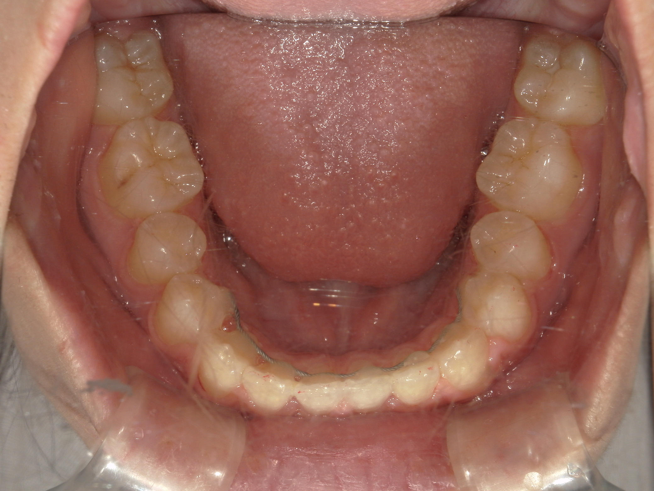 プチワイヤー矯正　症例（57）