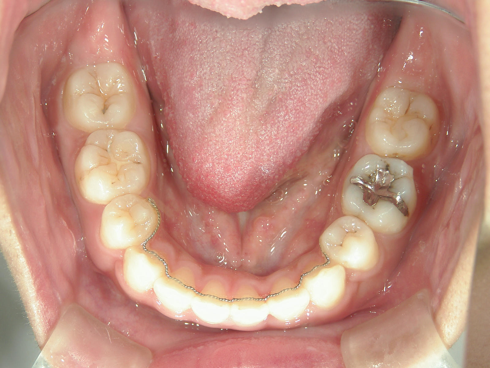 全顎ワイヤー矯正　症例（78）