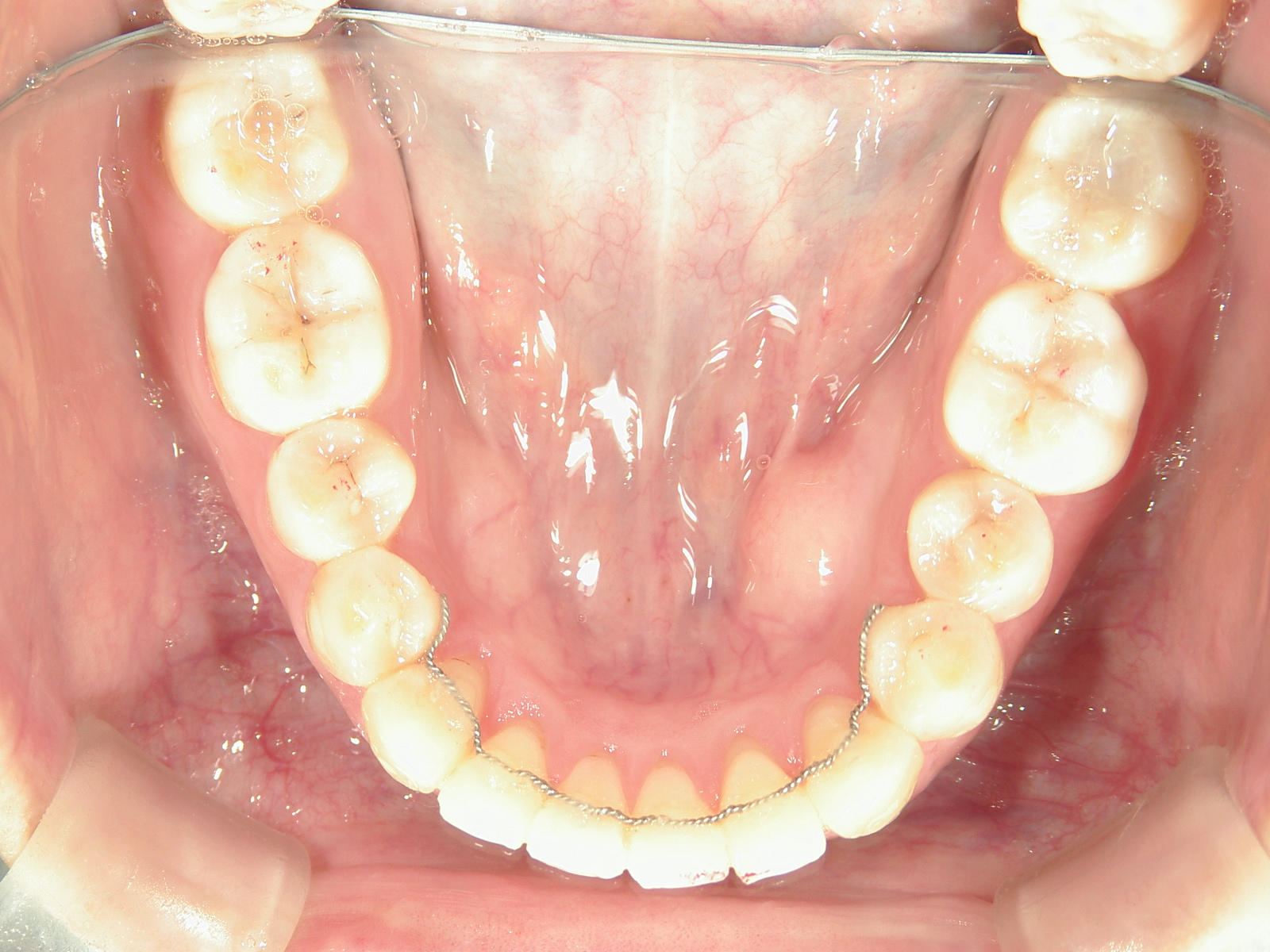 プチワイヤー矯正　症例（53）