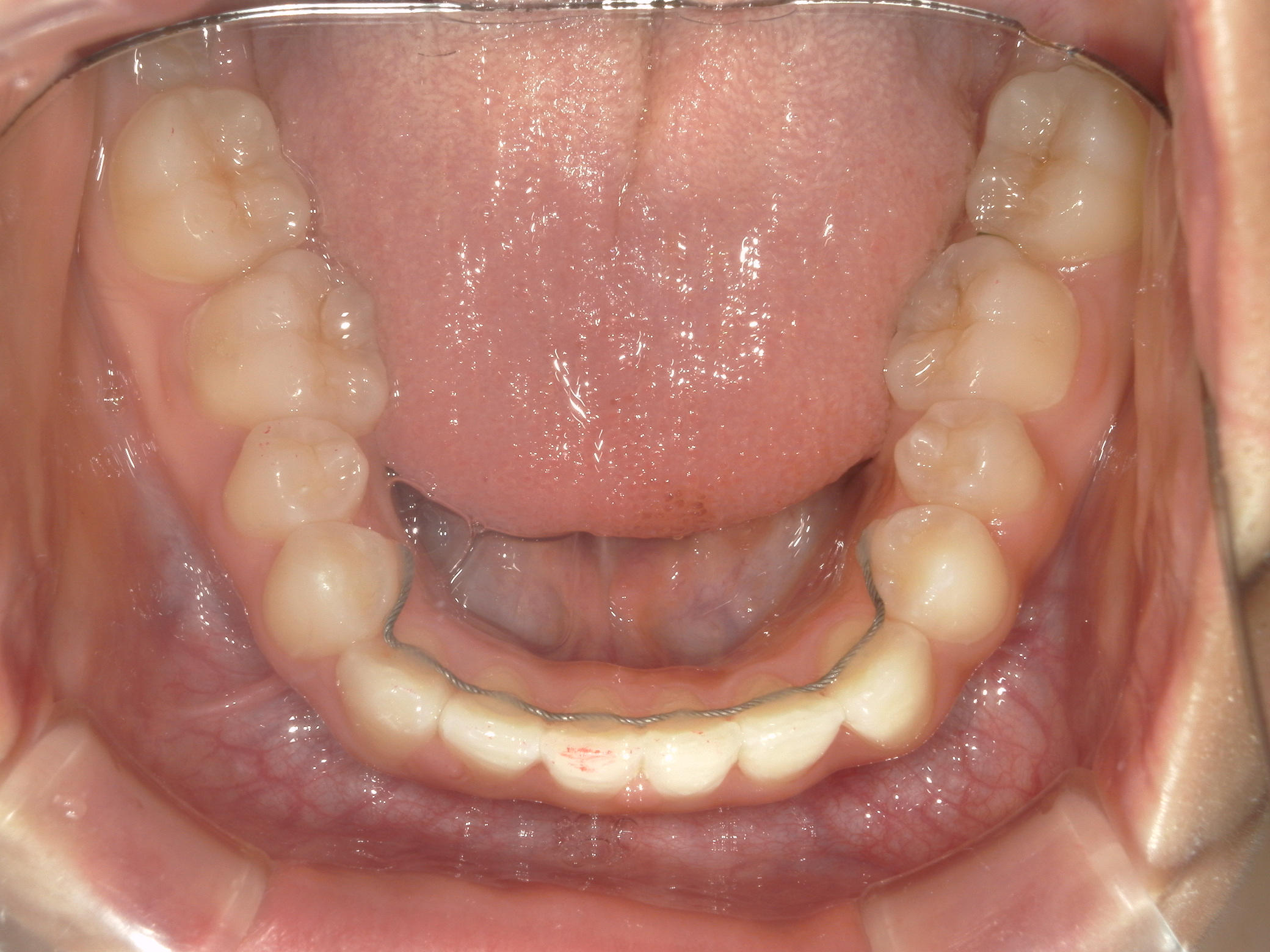 プチワイヤー矯正　症例（54）