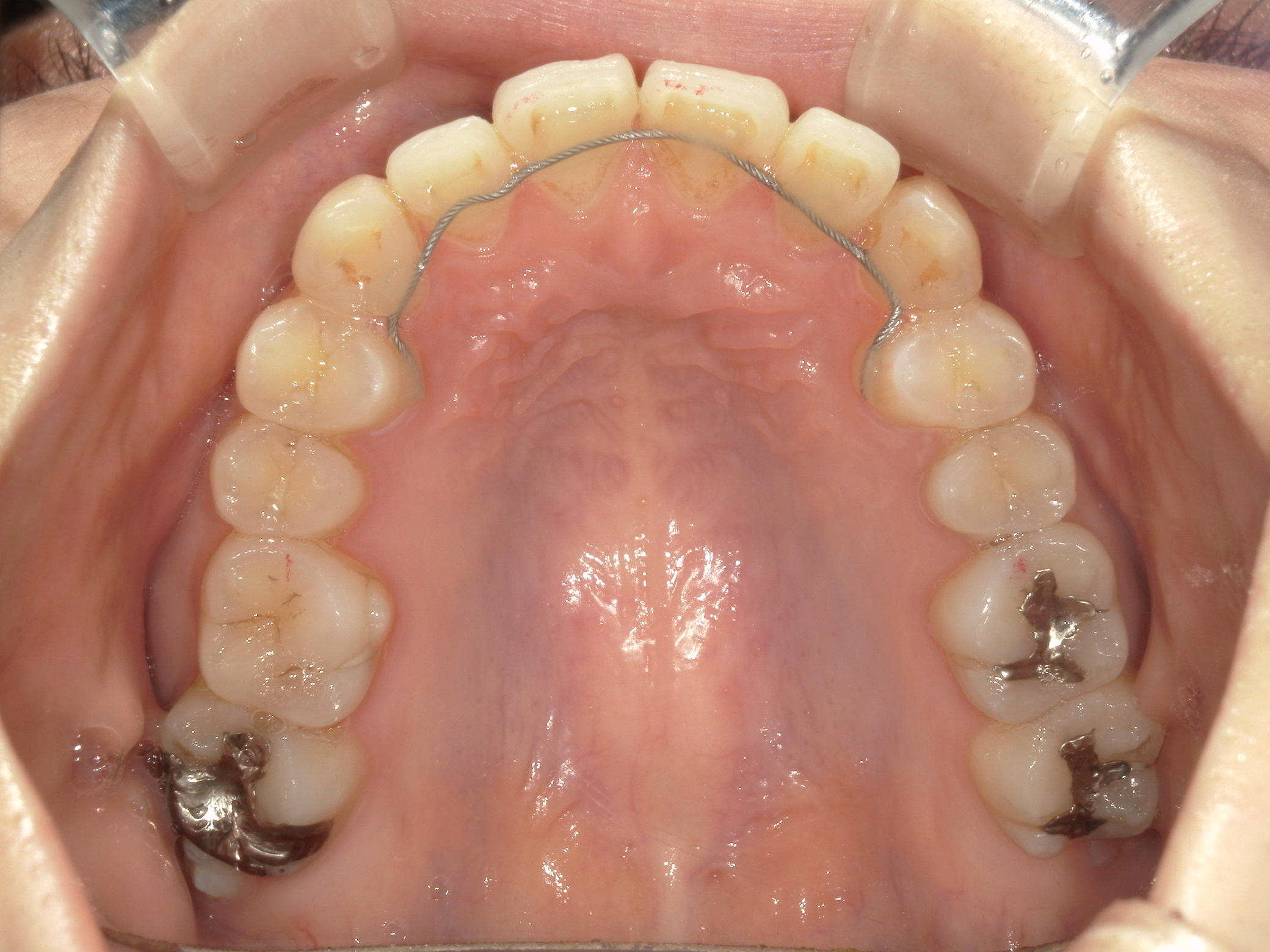 プチワイヤー矯正　症例（58）