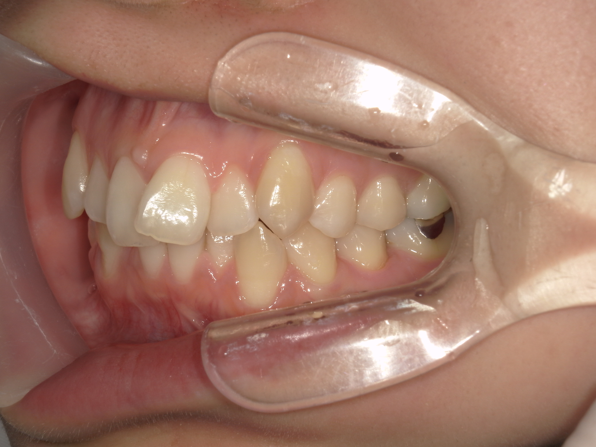 プチワイヤー矯正　症例（58）