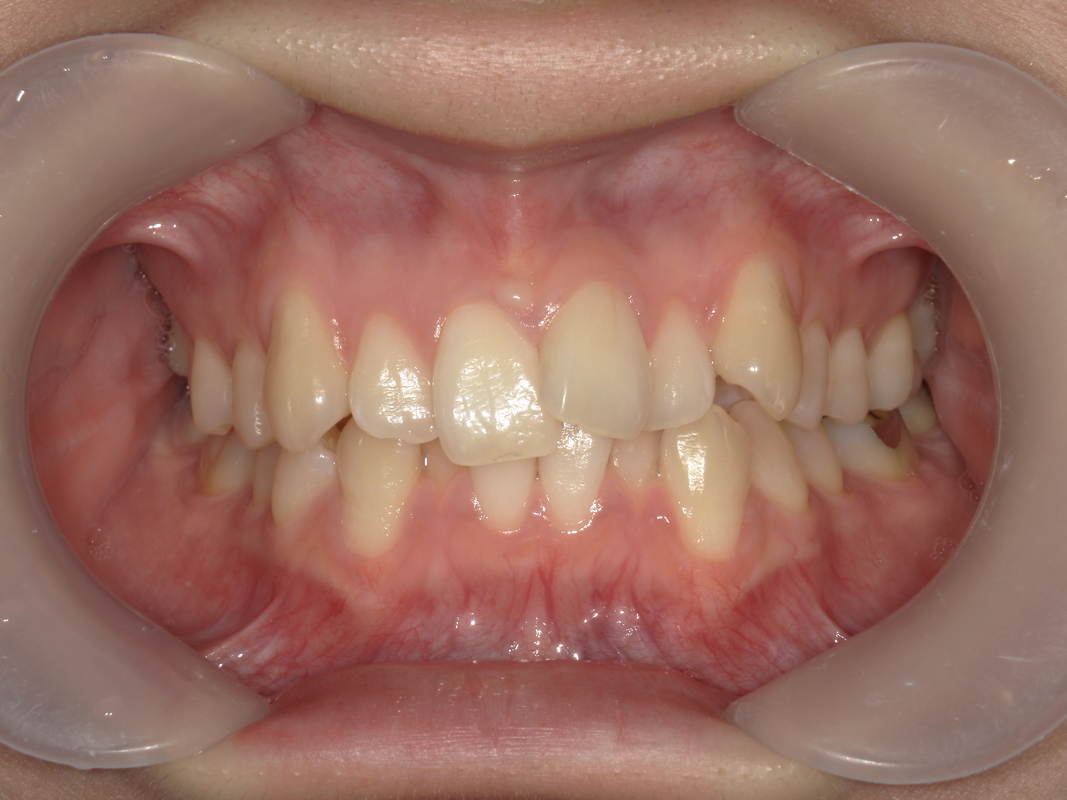 プチワイヤー矯正　症例（58）