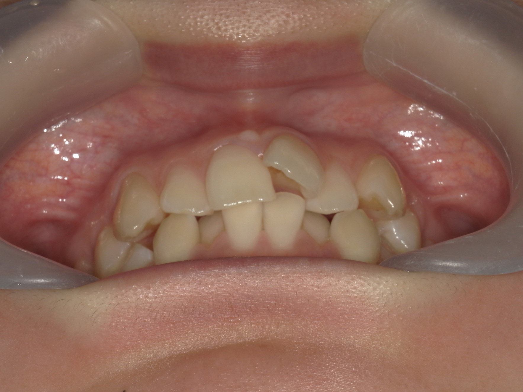 プチワイヤー矯正　症例（58）