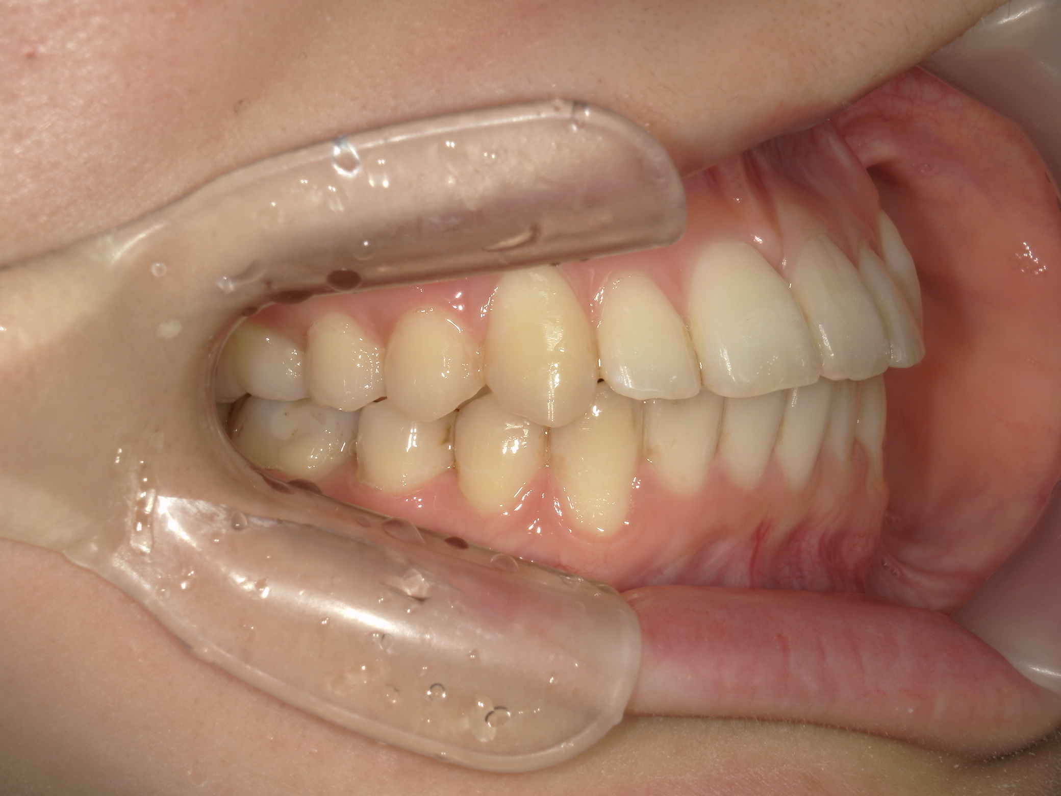 プチワイヤー矯正　症例（58）