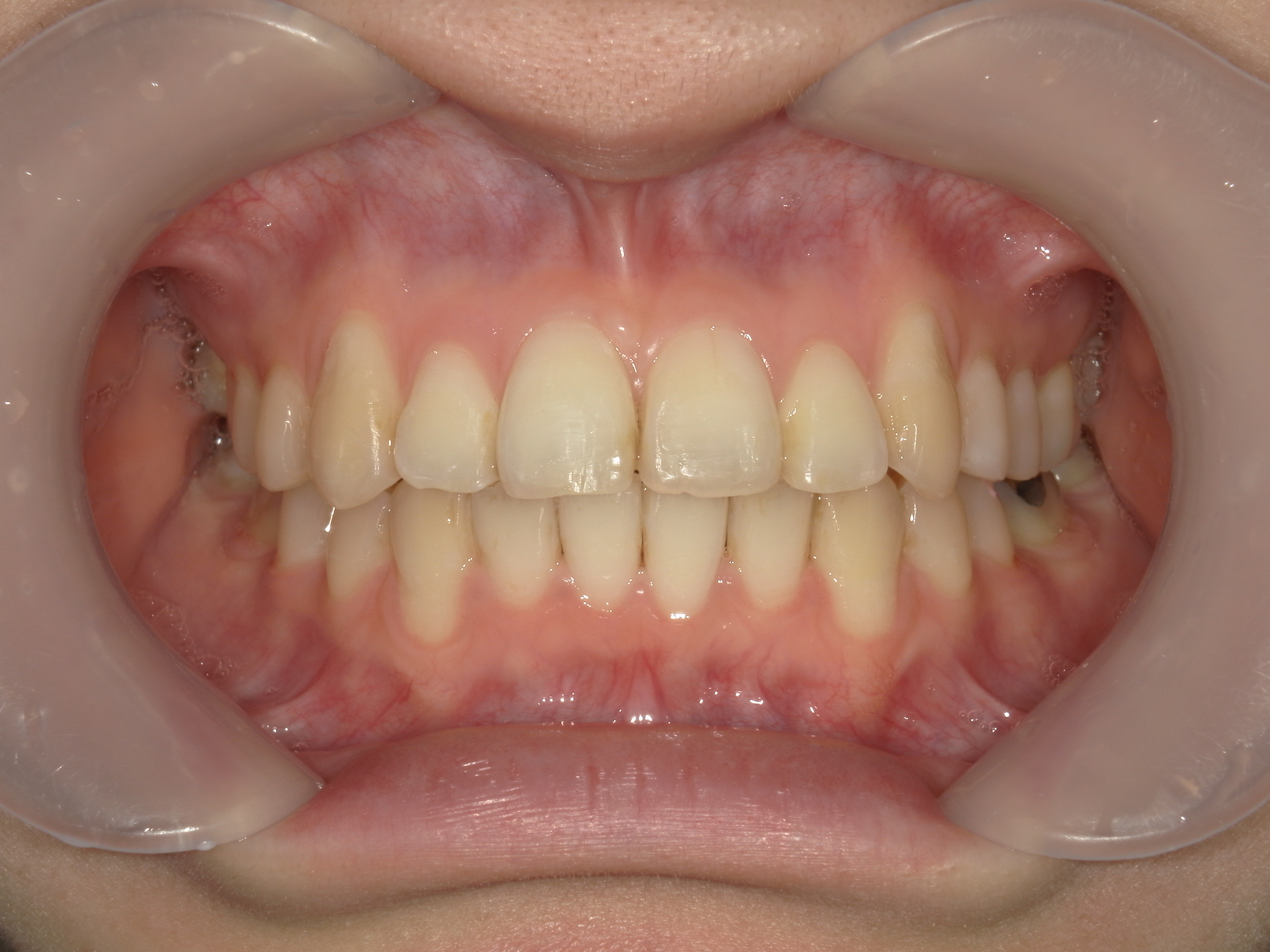 プチワイヤー矯正　症例（58）